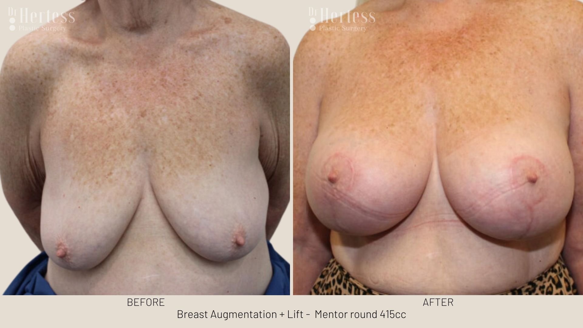 breast uplift mastopexy