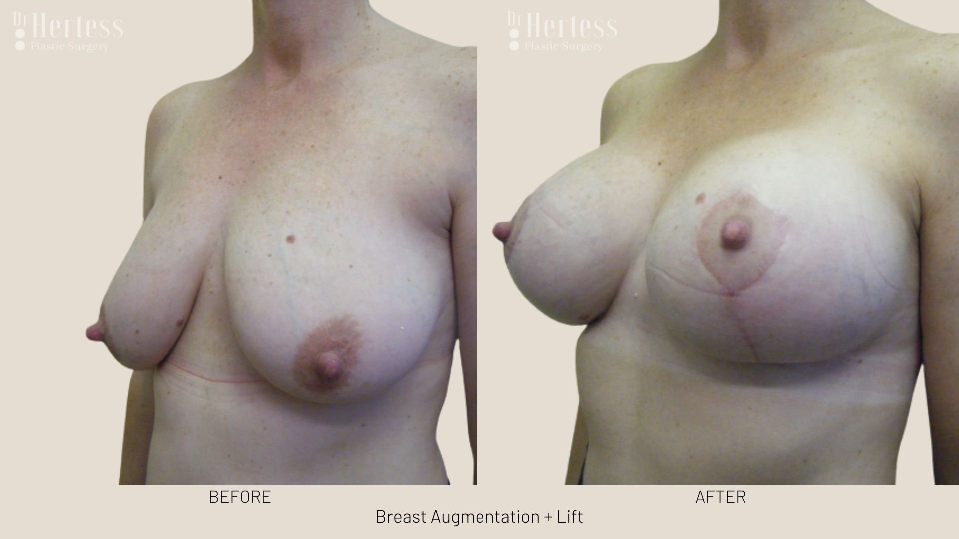 breast lift and augmentation before and after