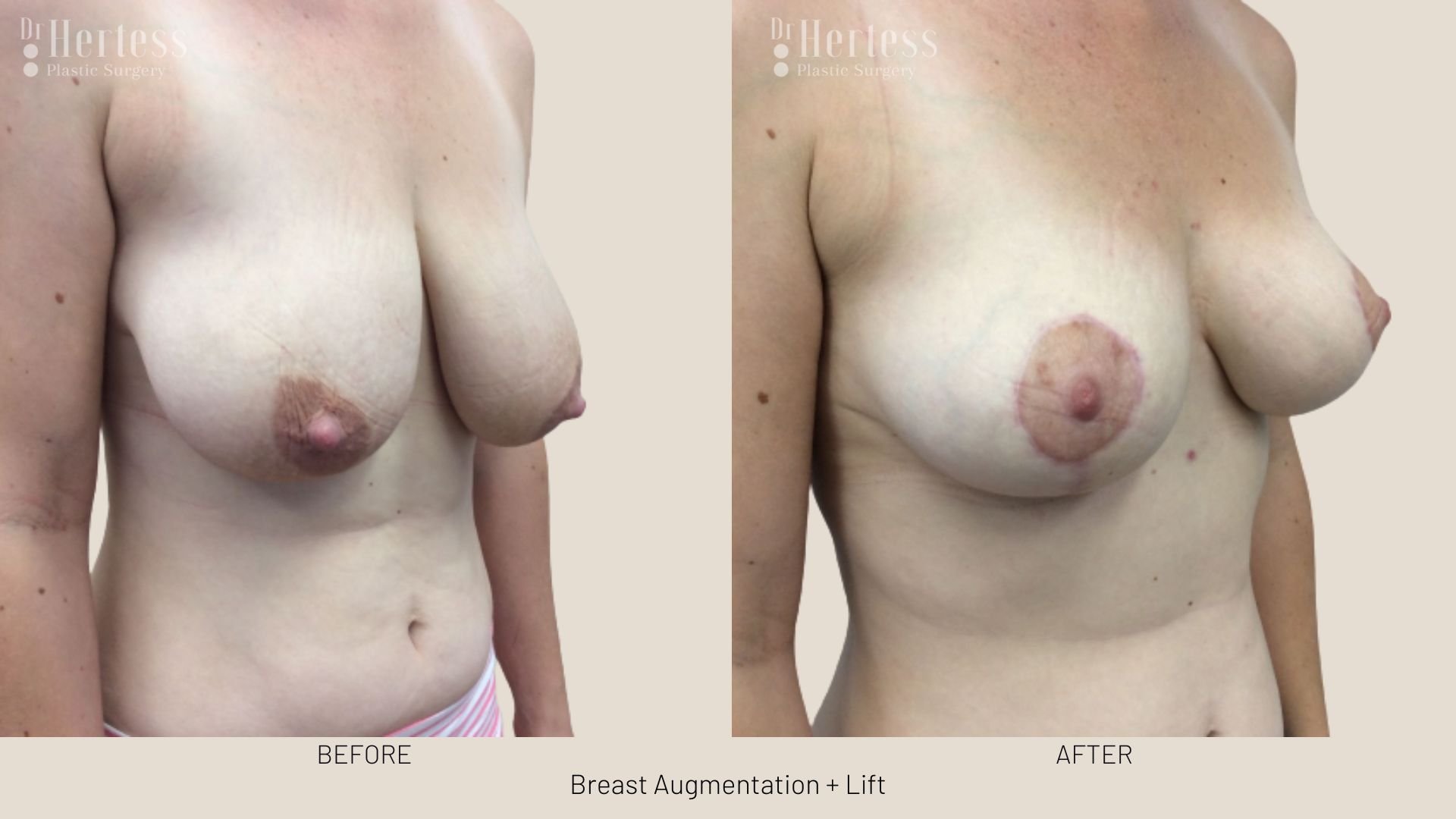 breast lift and augmentation before and after