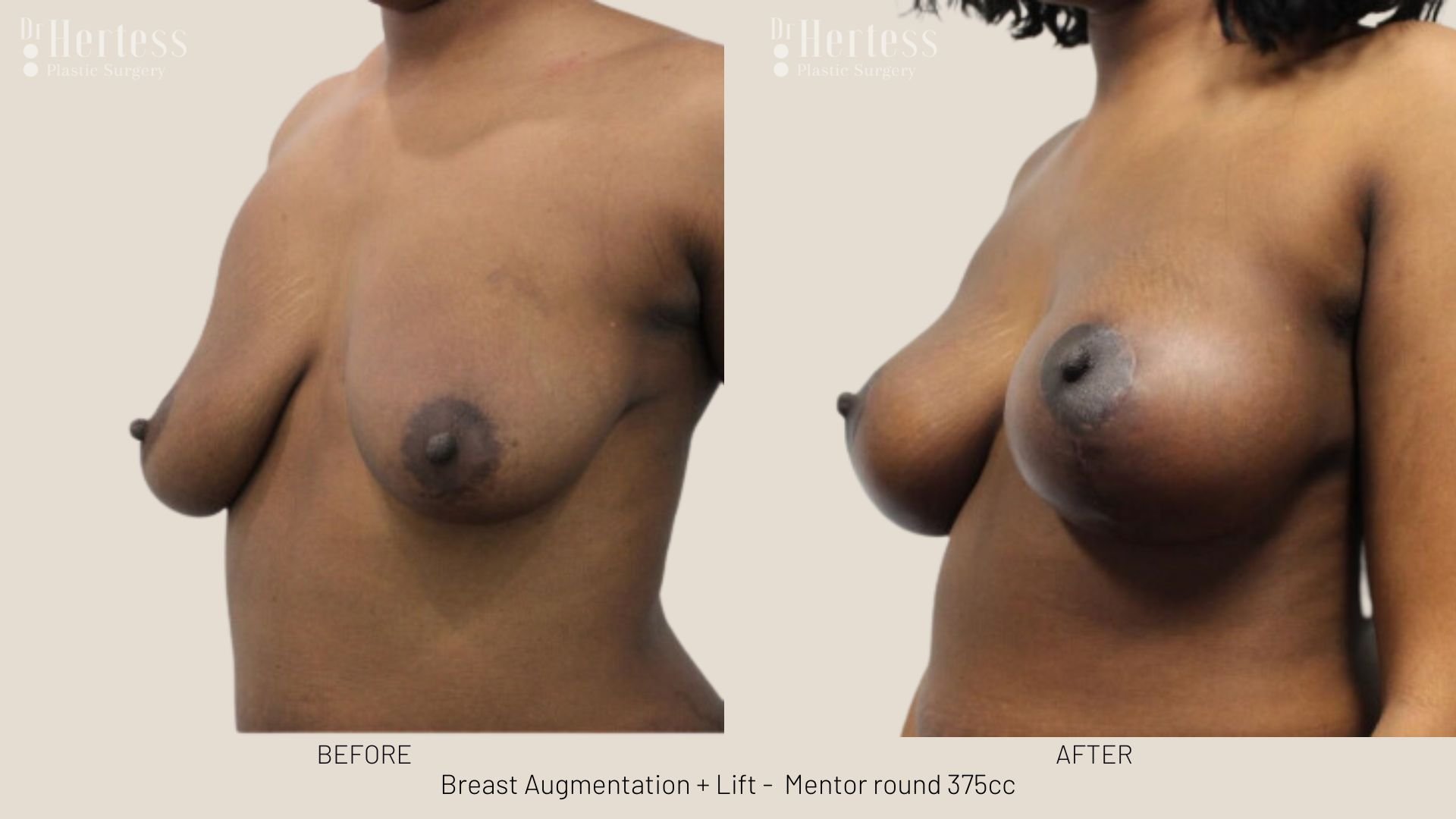 breast uplift mastopexy