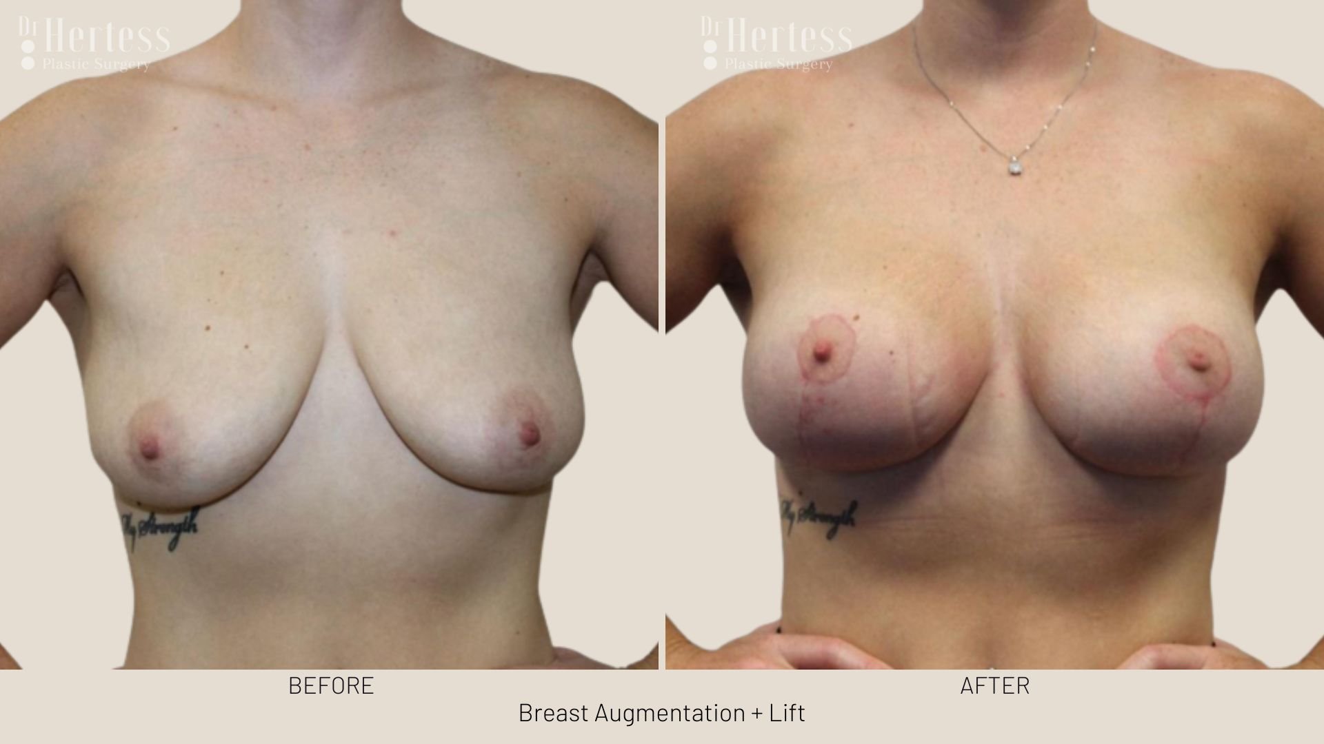 breast lift and augmentation before and after