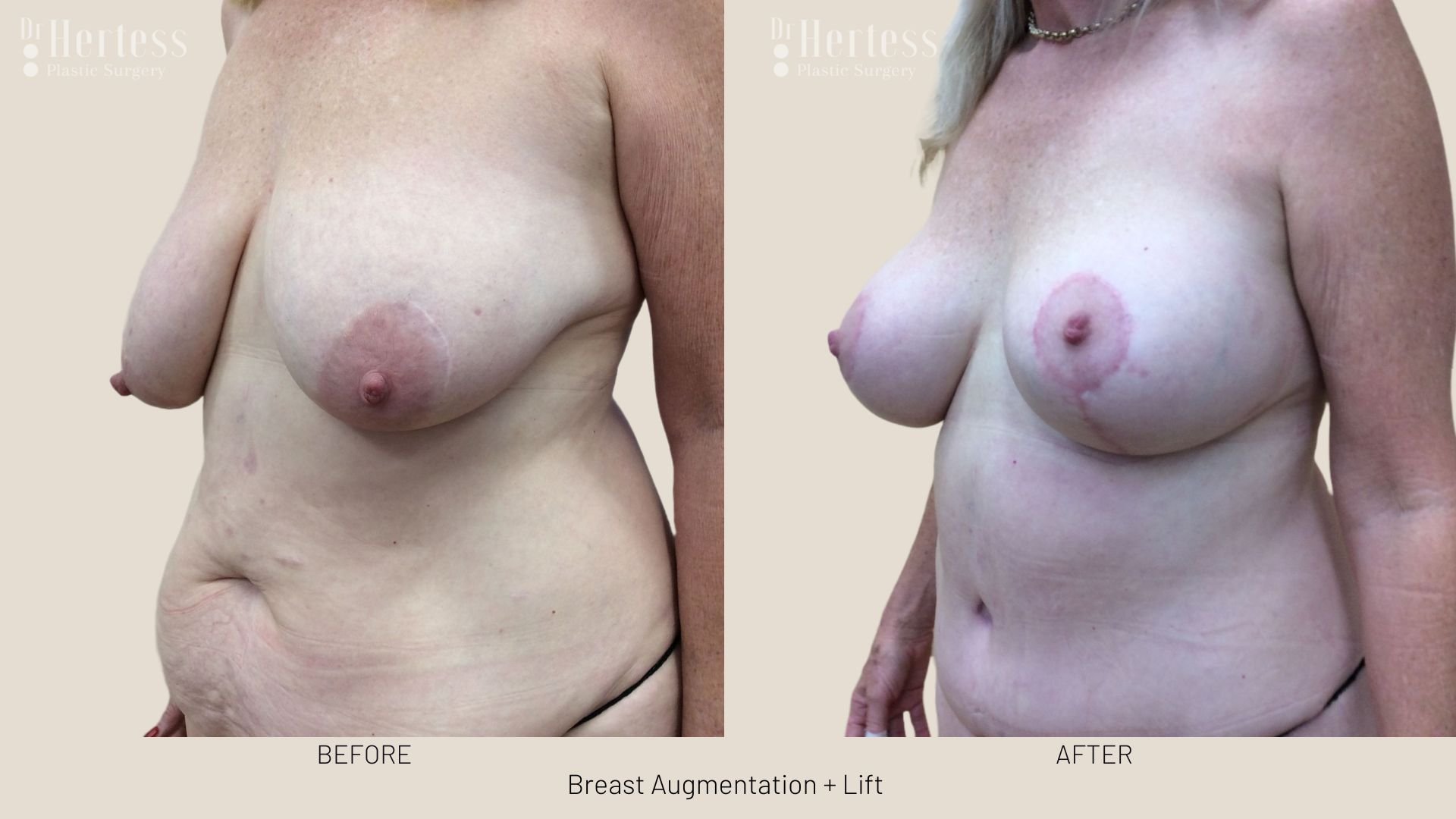 breast lift with augmentation before and after