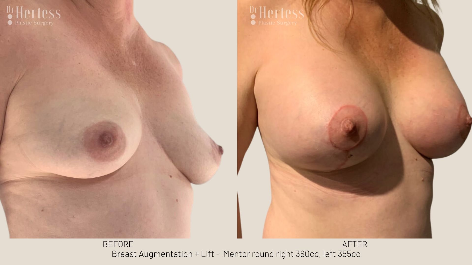 breast lift before and afters
