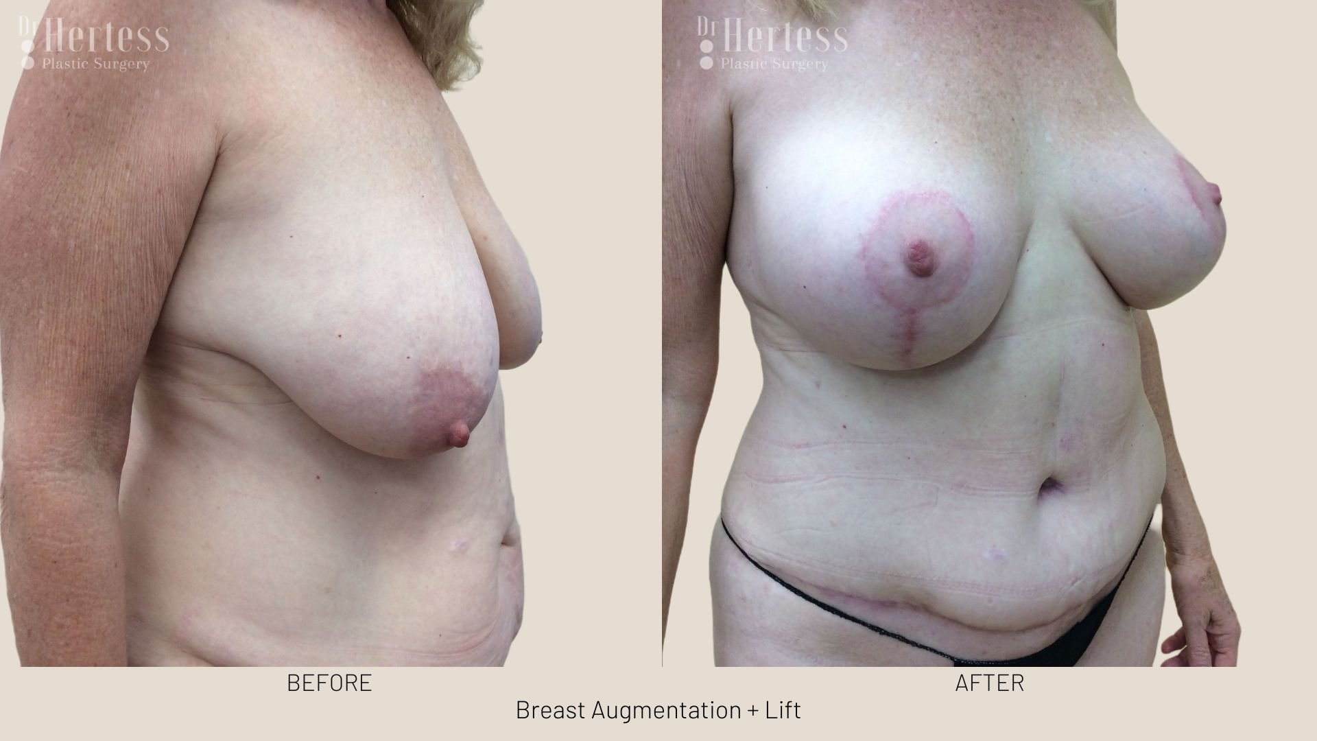 breast lift with augmentation before and after