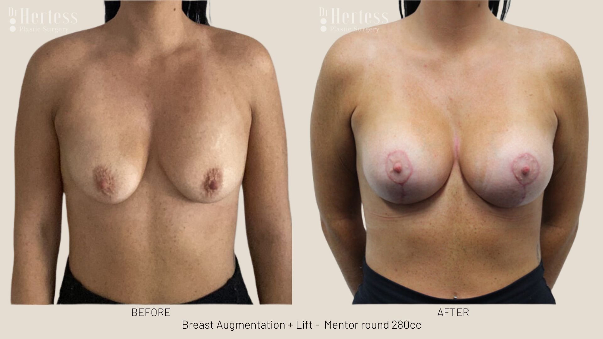 breast uplift mastopexy