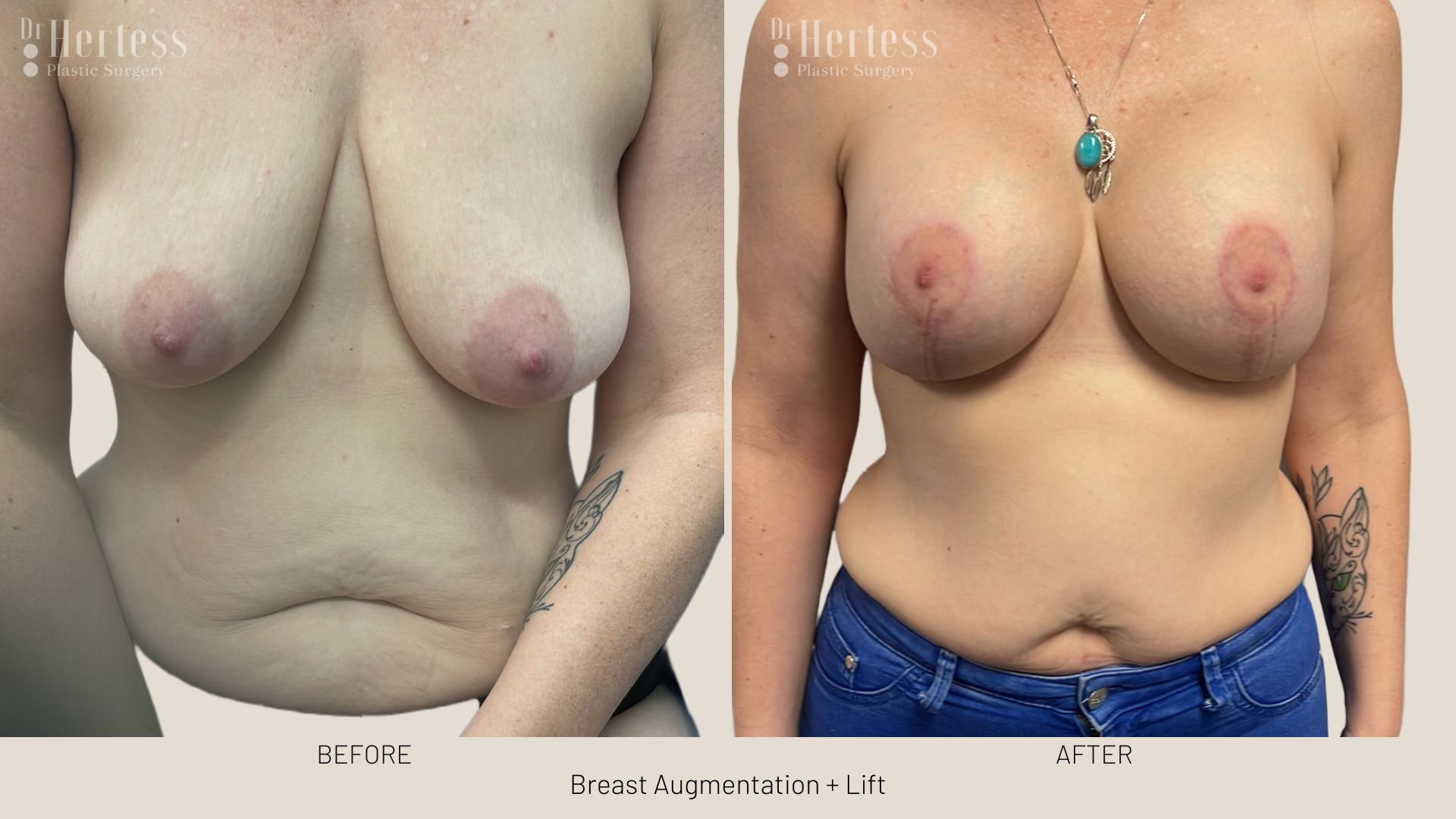 breast lift with augmentation before and after