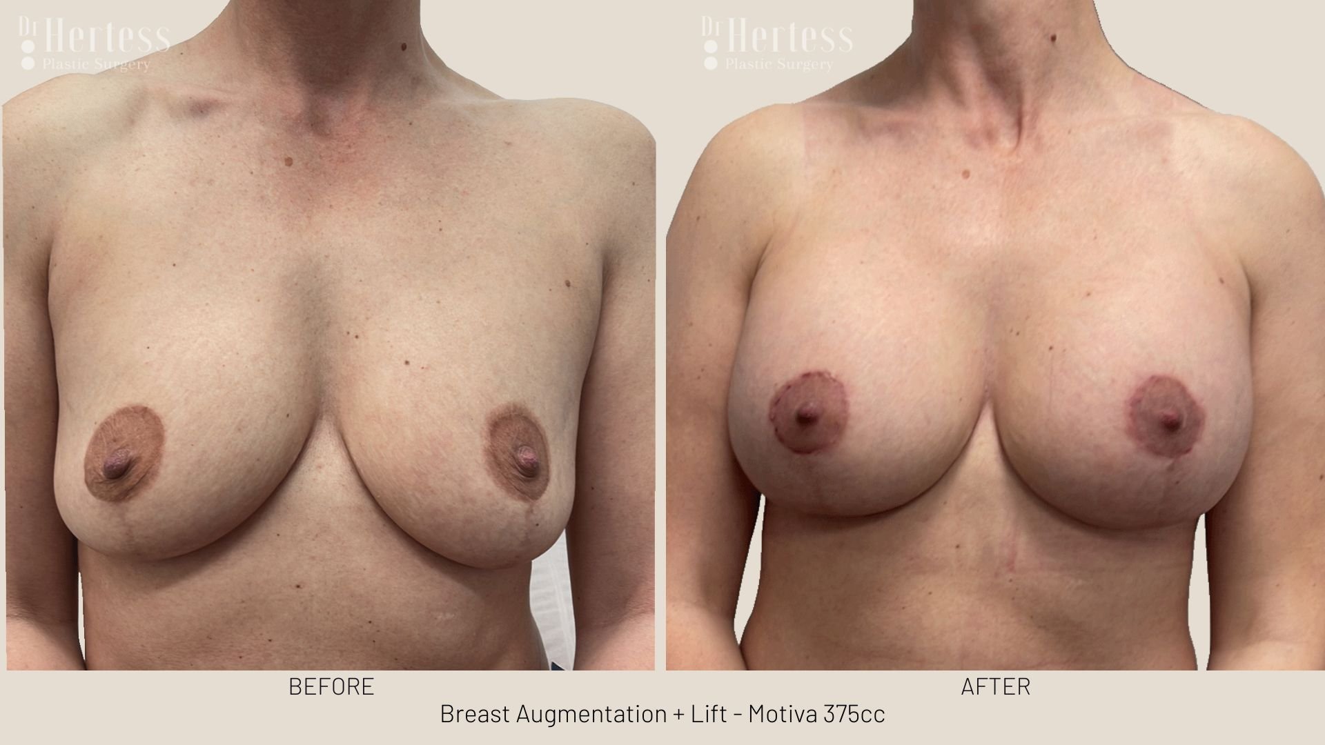 breast lift before and afters