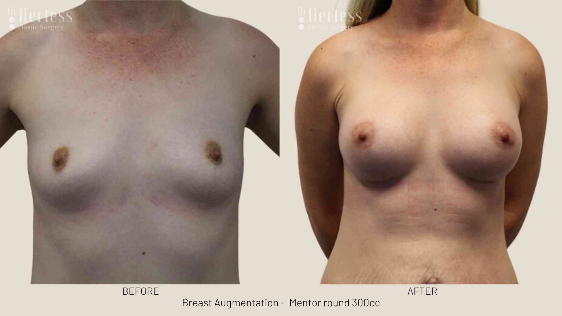breast implant pics