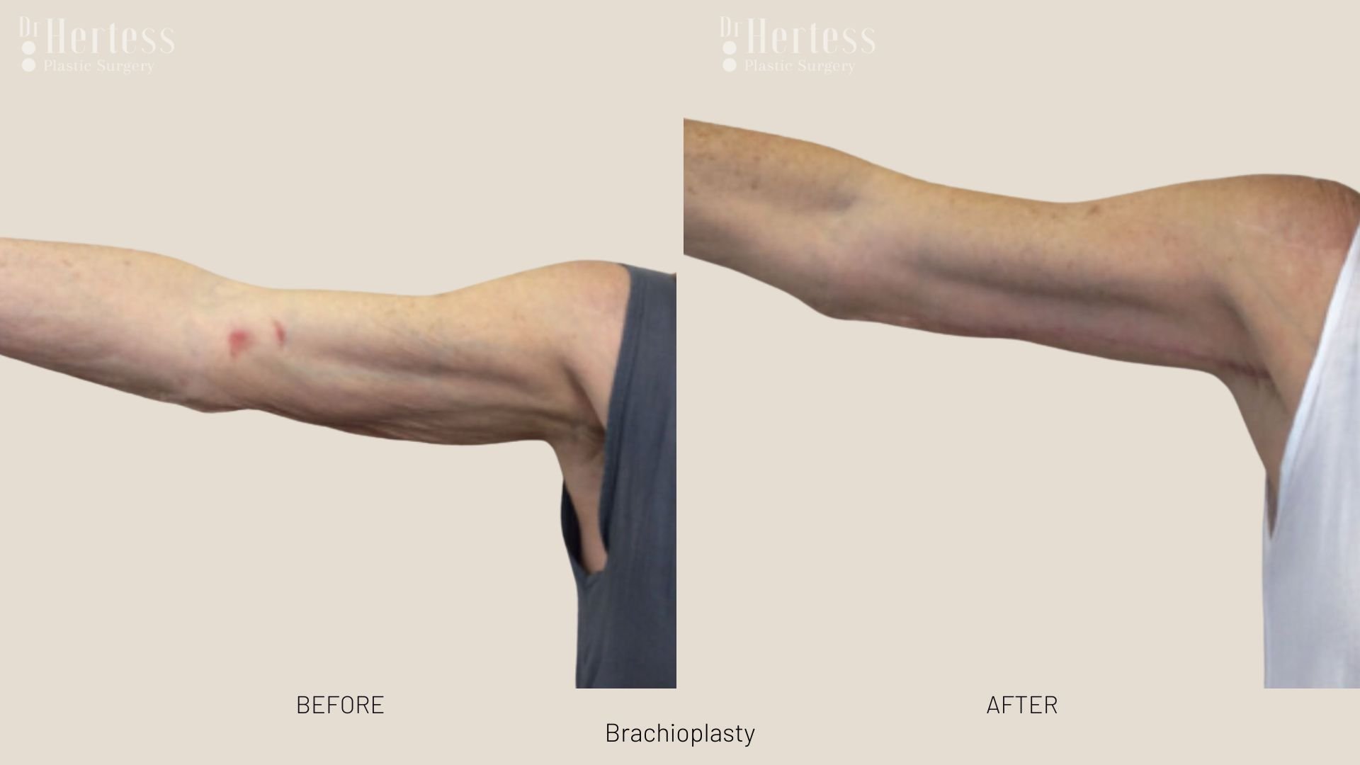 arm lift before after