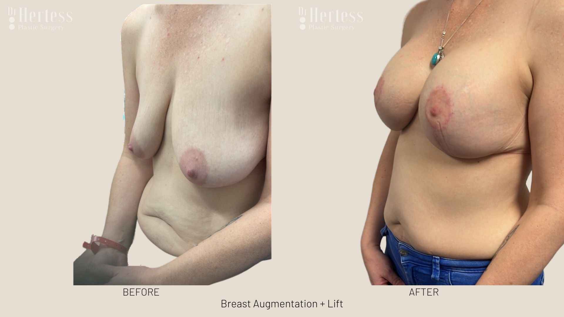 breast lift with augmentation before and after