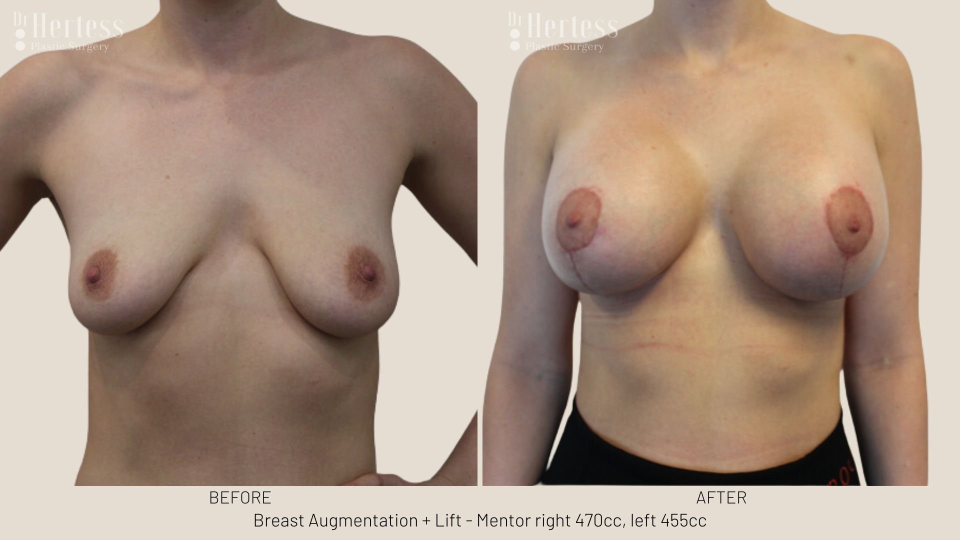 breast uplift mastopexy