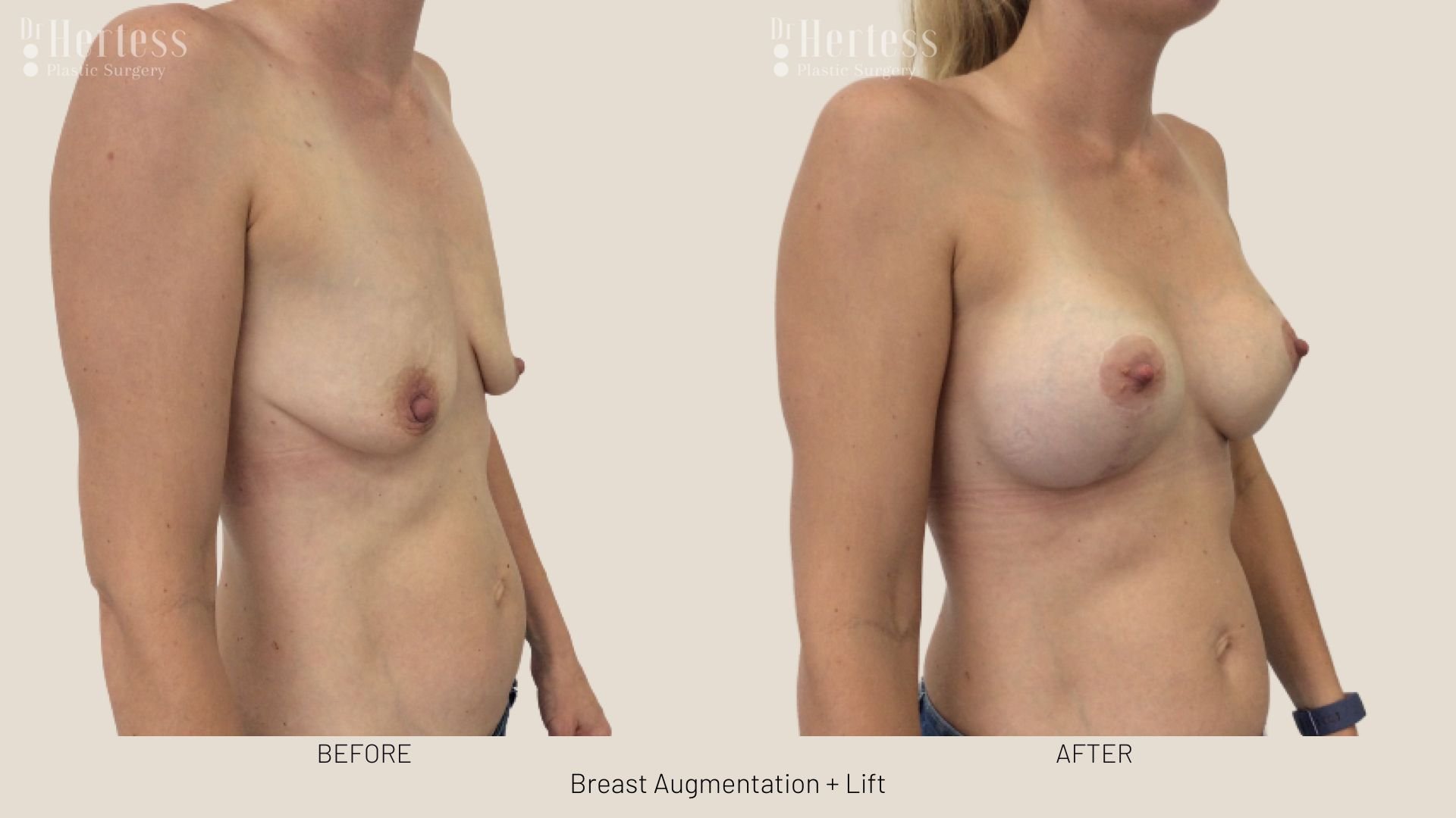 breast lift with augmentation before and after