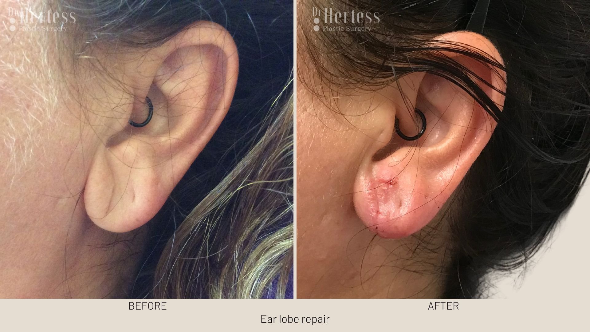 stretched ear lobe