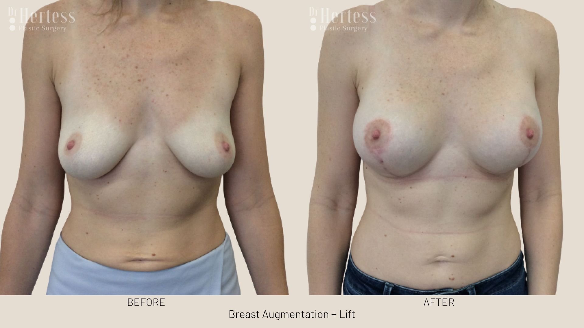 233-1breast lift with augmentation before and after