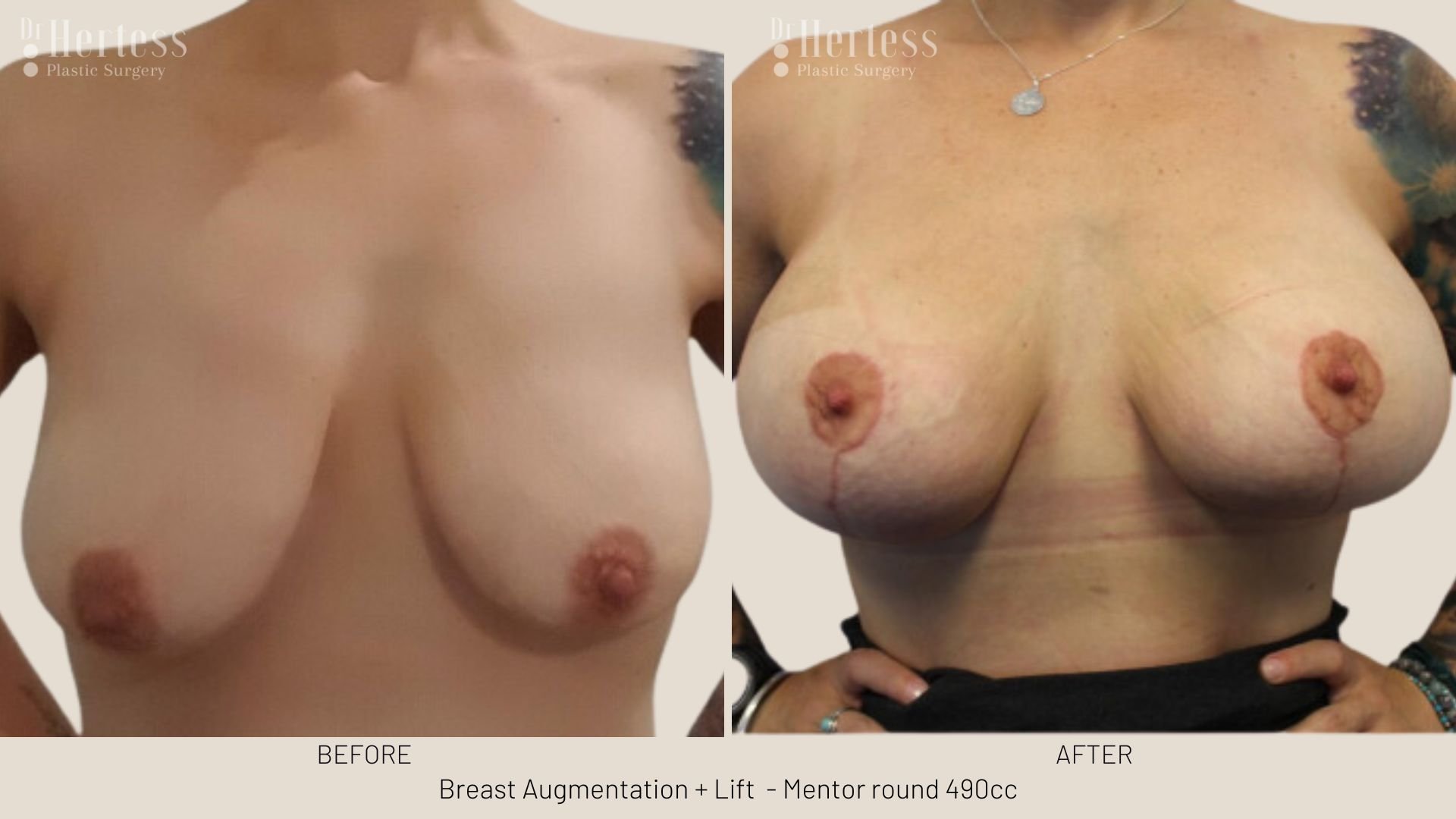 breast uplift mastopexy