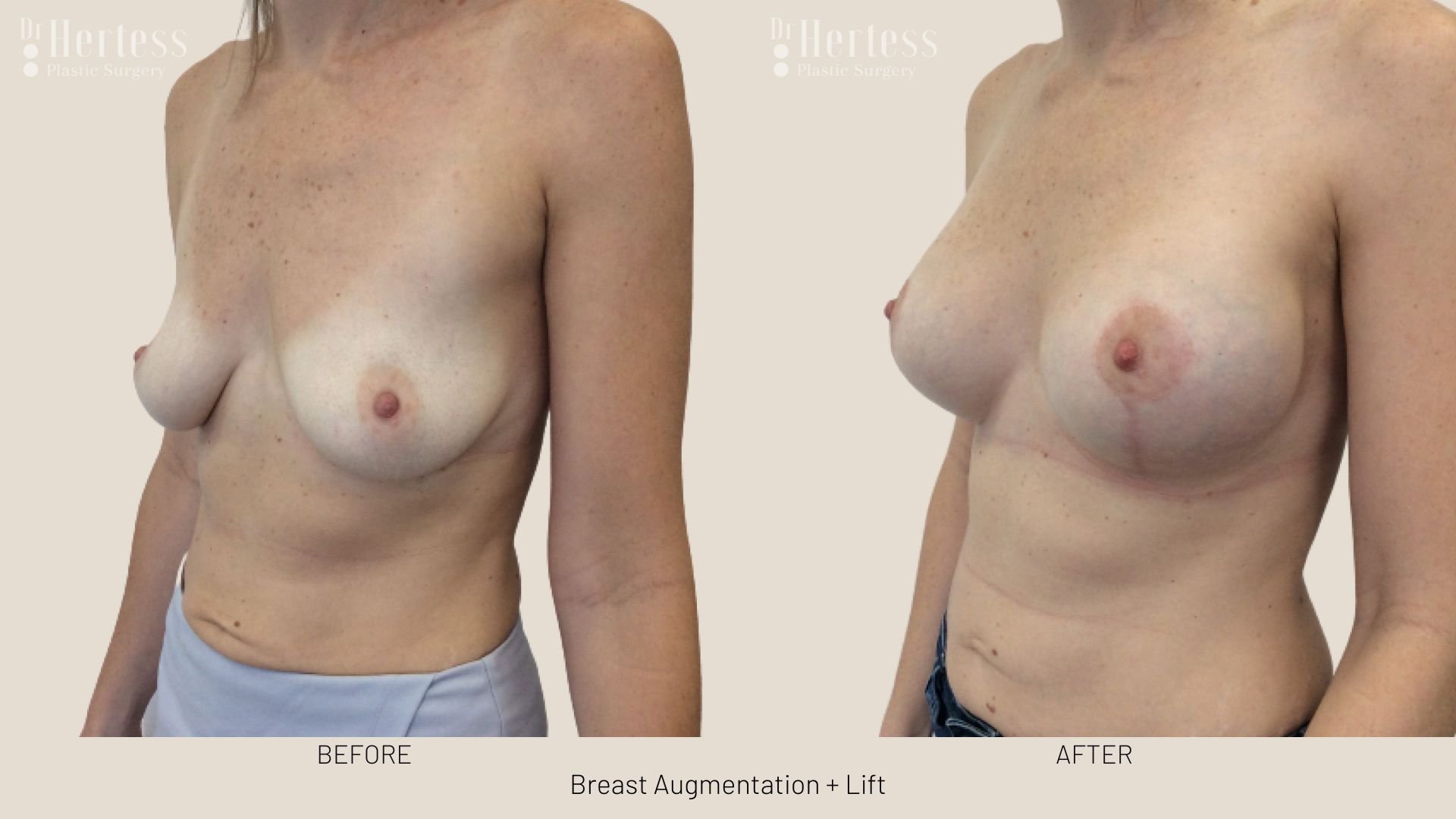 breast lift with augmentation before and after