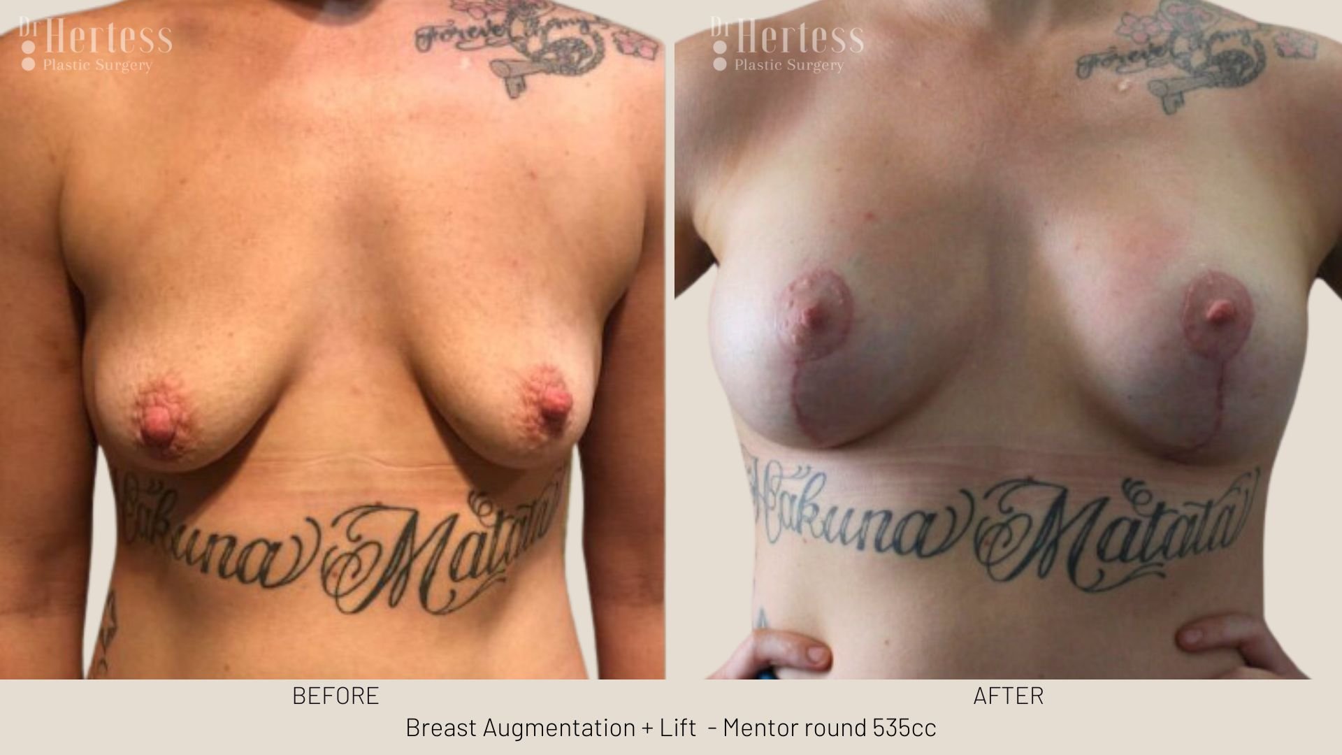 breast uplift mastopexy