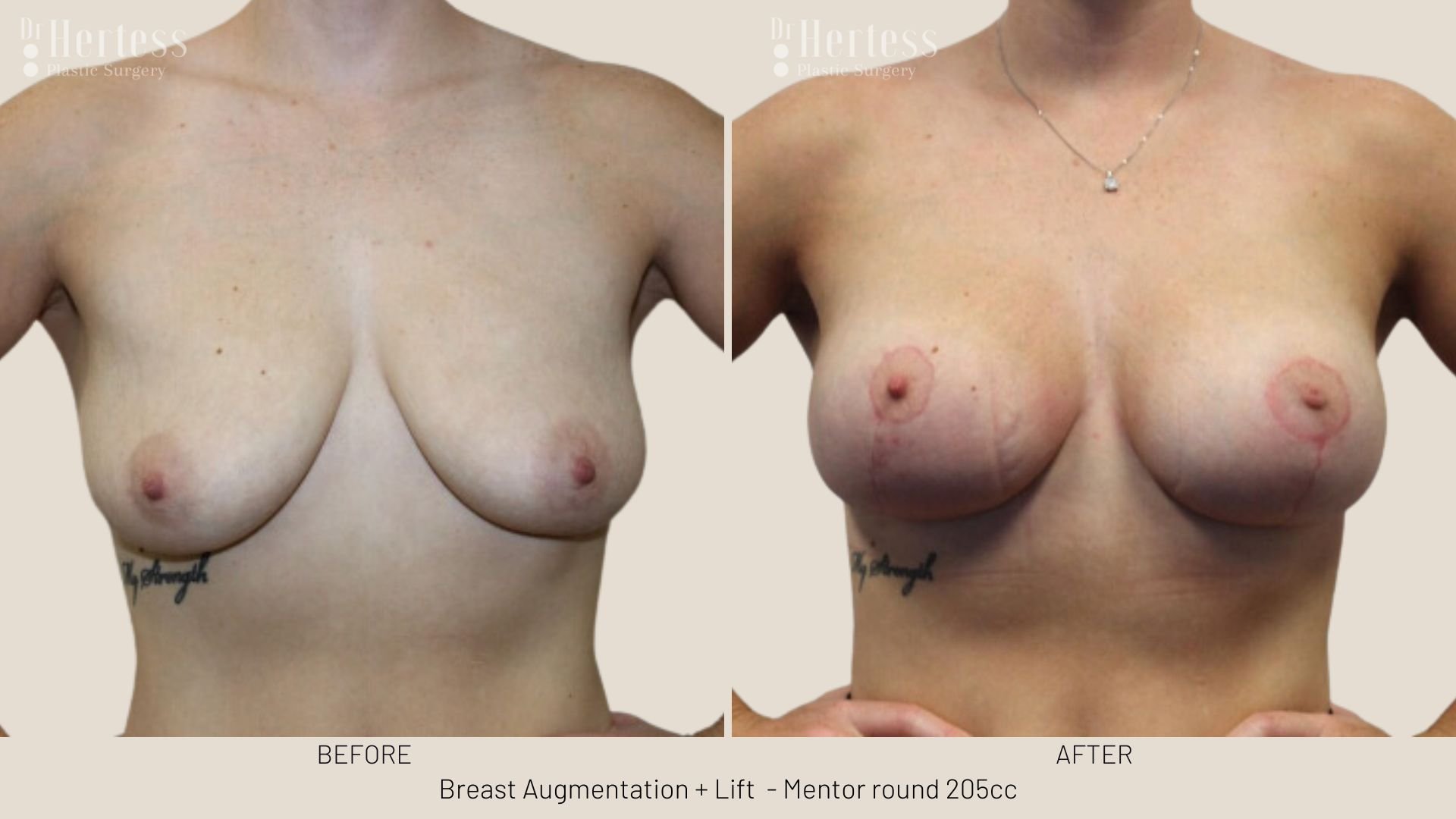 breast uplift mastopexy