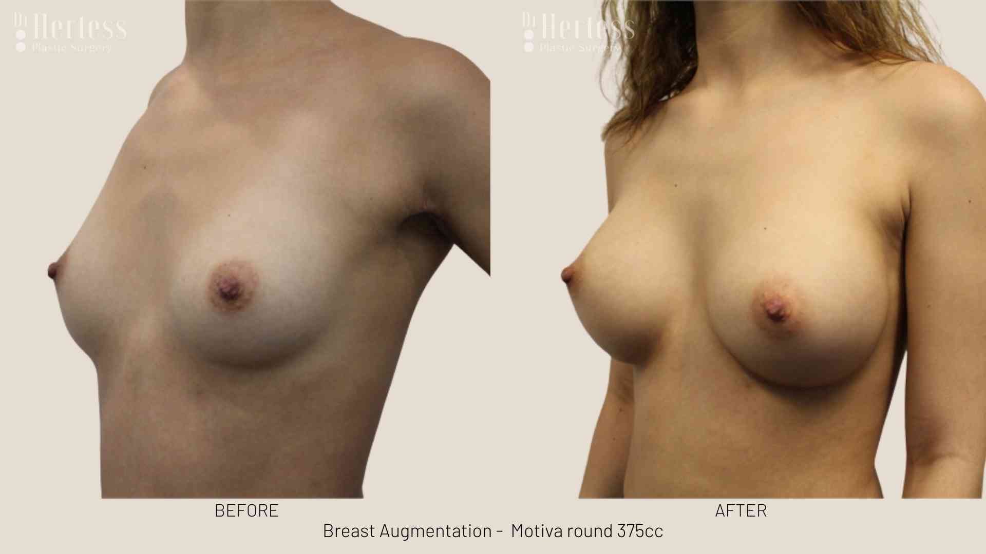 breast enlargement before and after