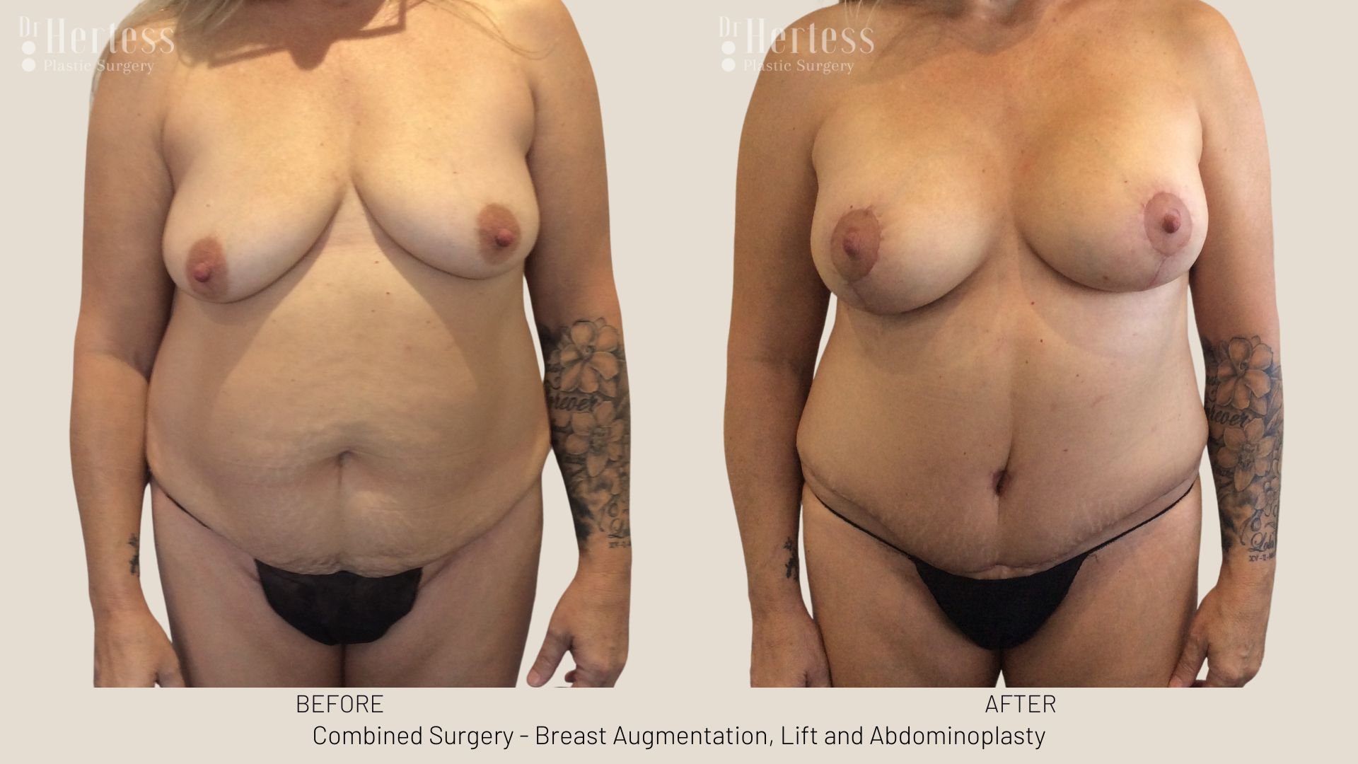 tummy tuck after pregnancy