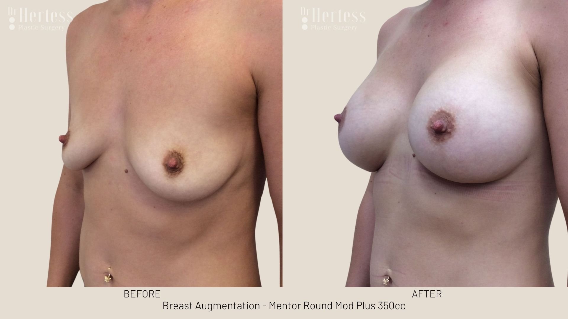 breast aug before and after