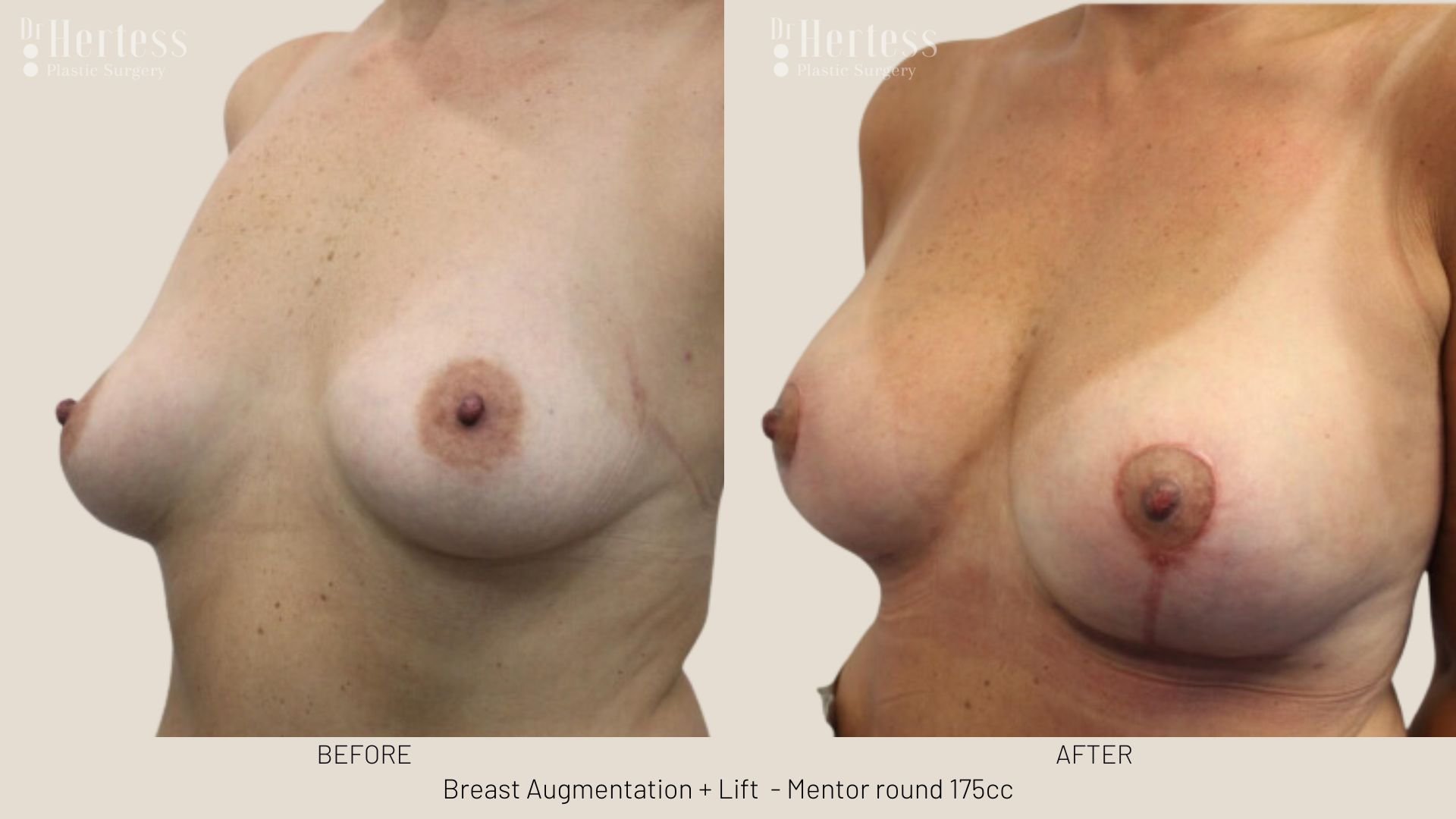 breast lift before and afters