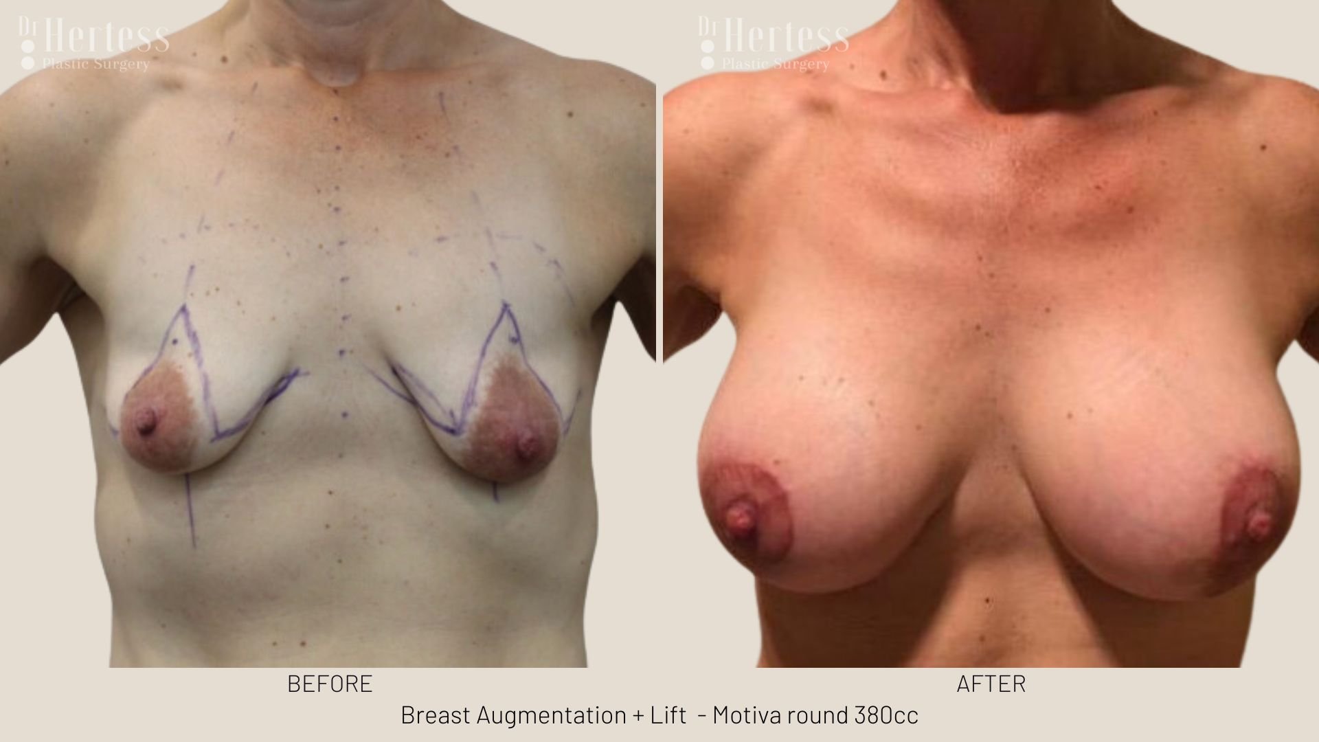 breast lift before and afters