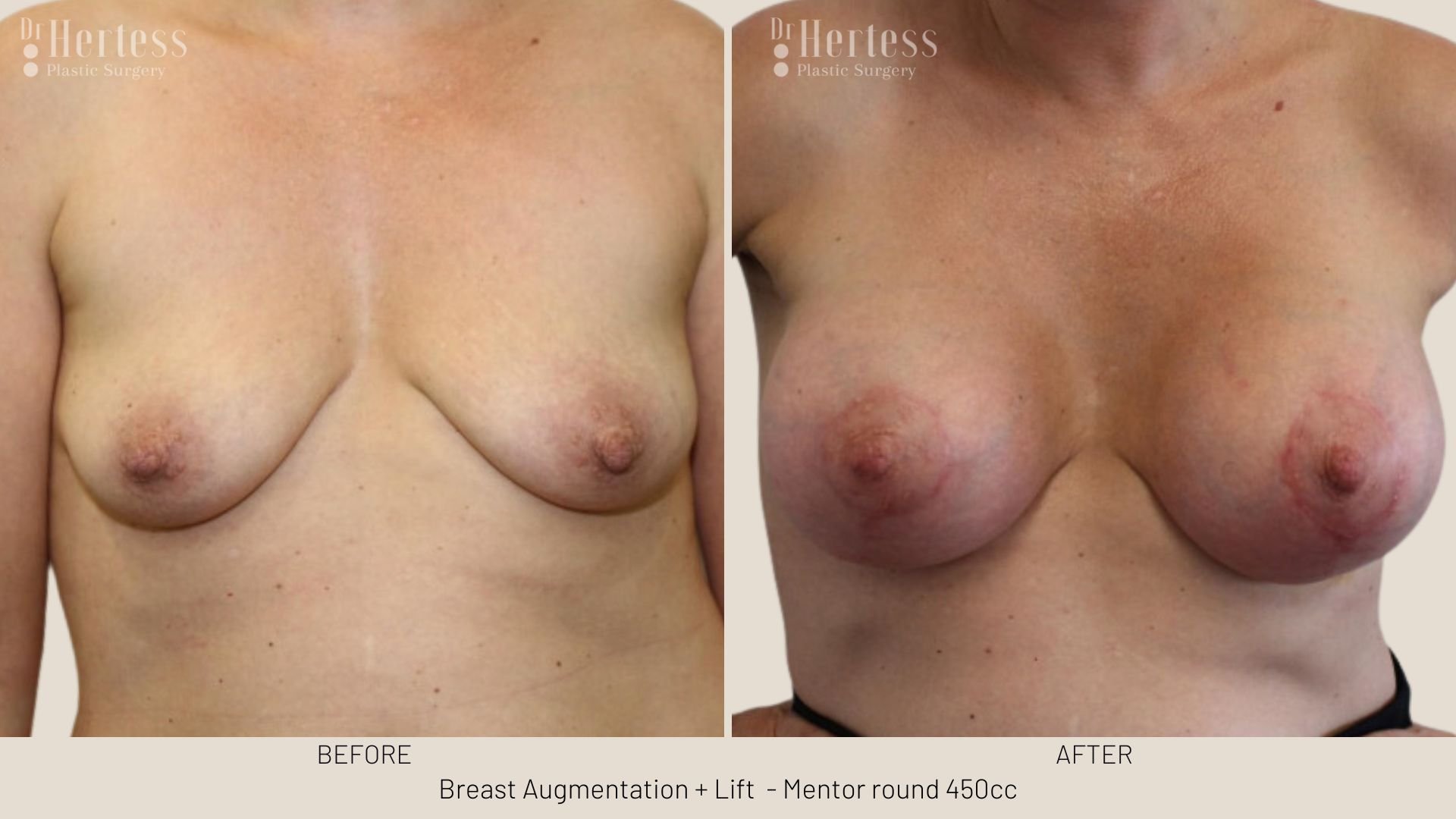 breast lift before and afters