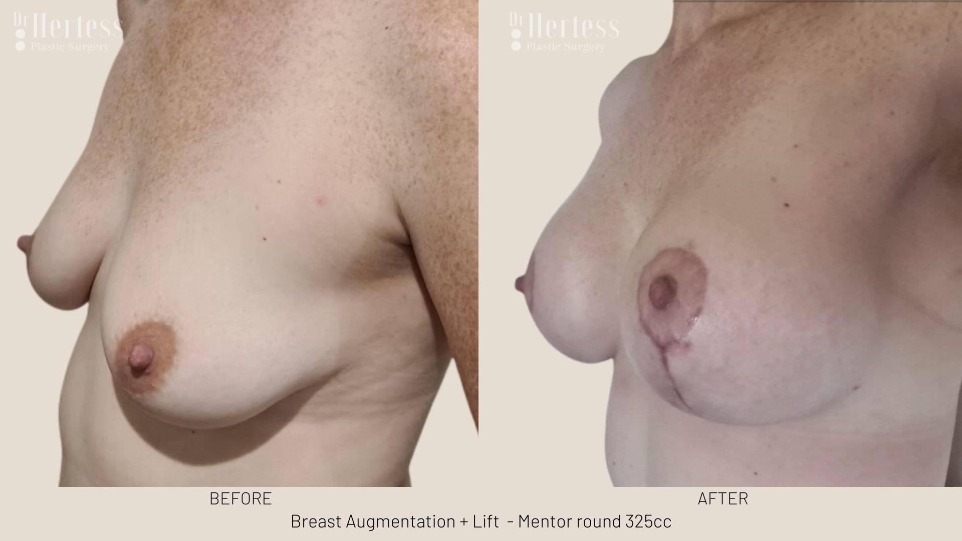 breast lift before and afters