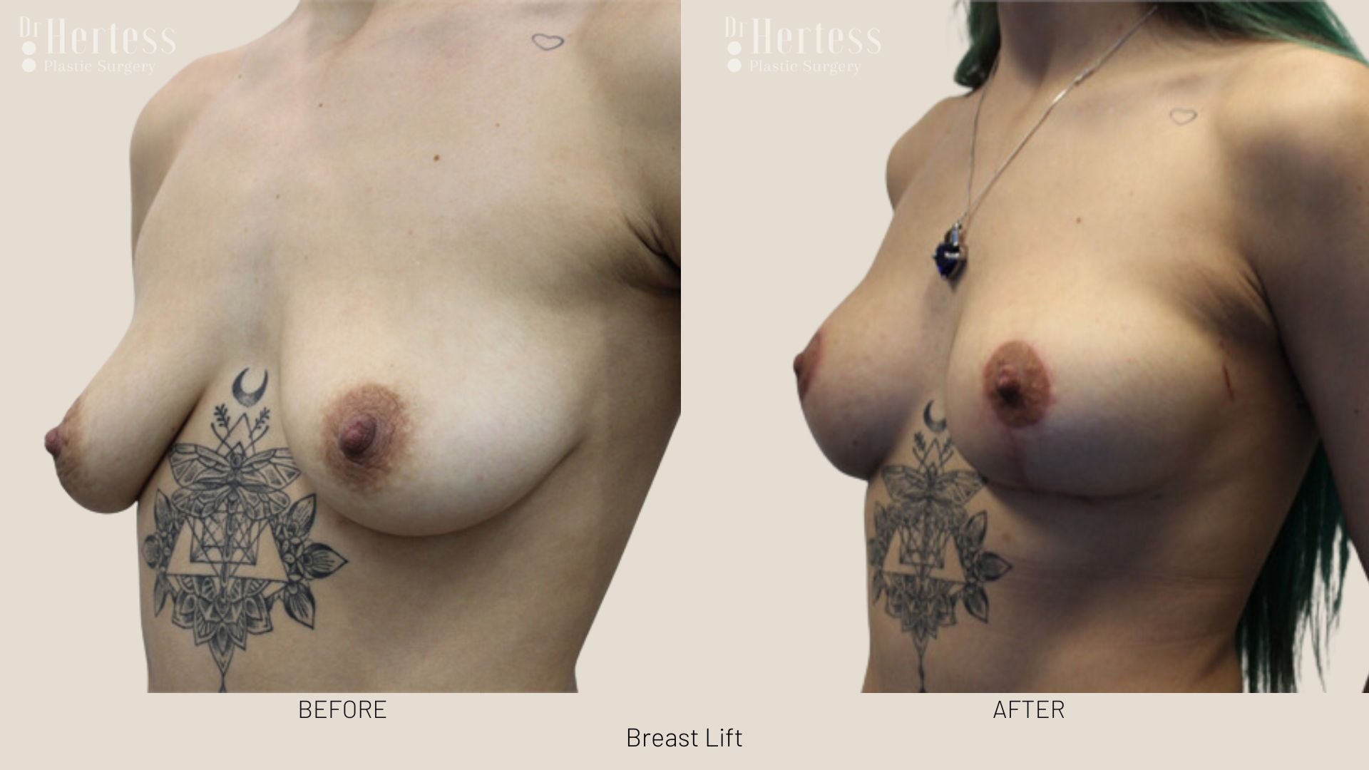 before and after breast uplift