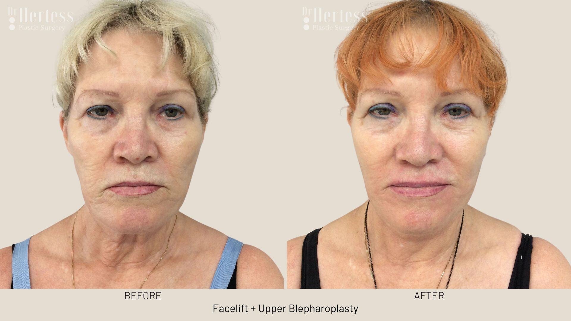 facelift before and after photos