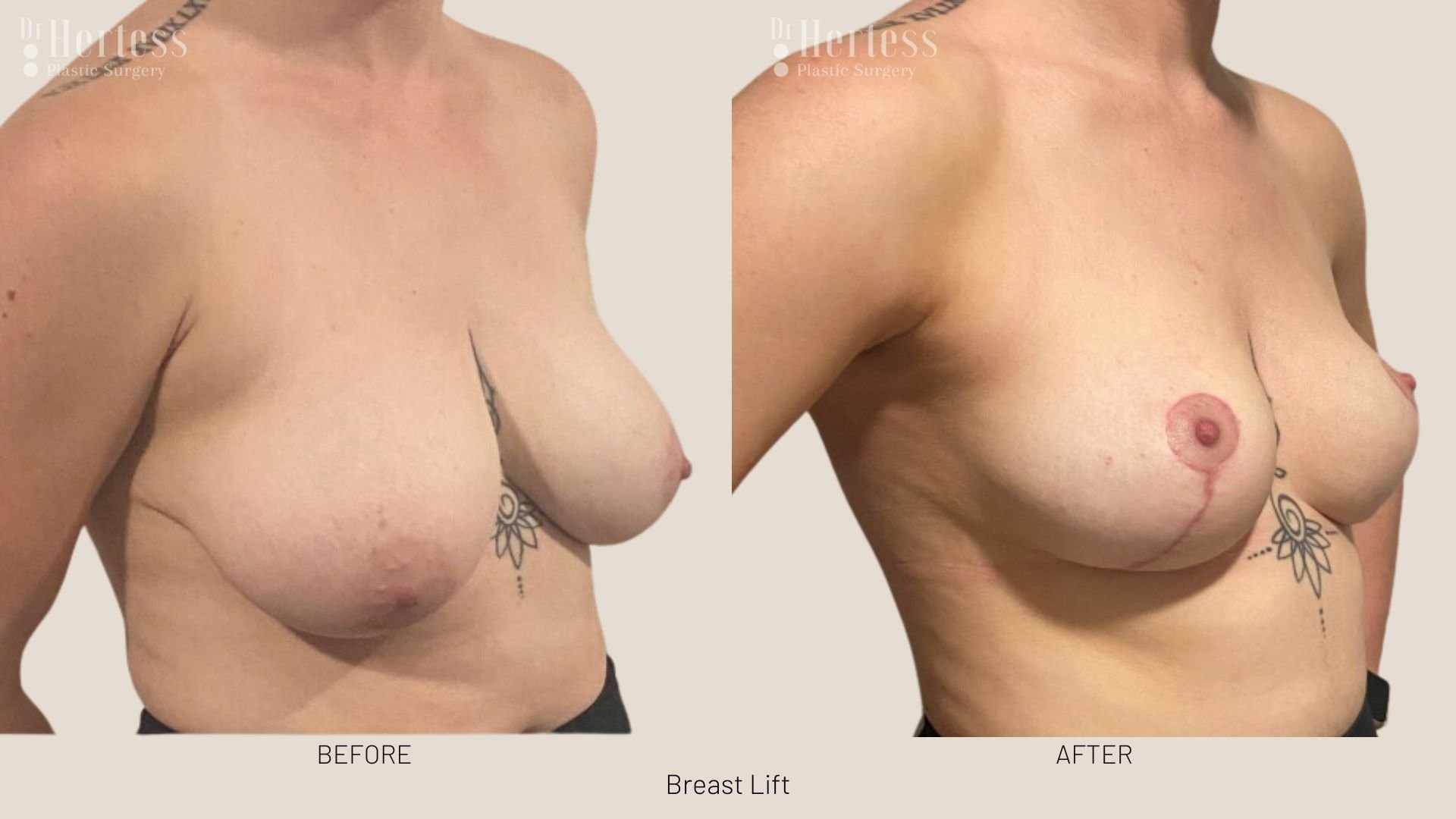 before and after breast uplift