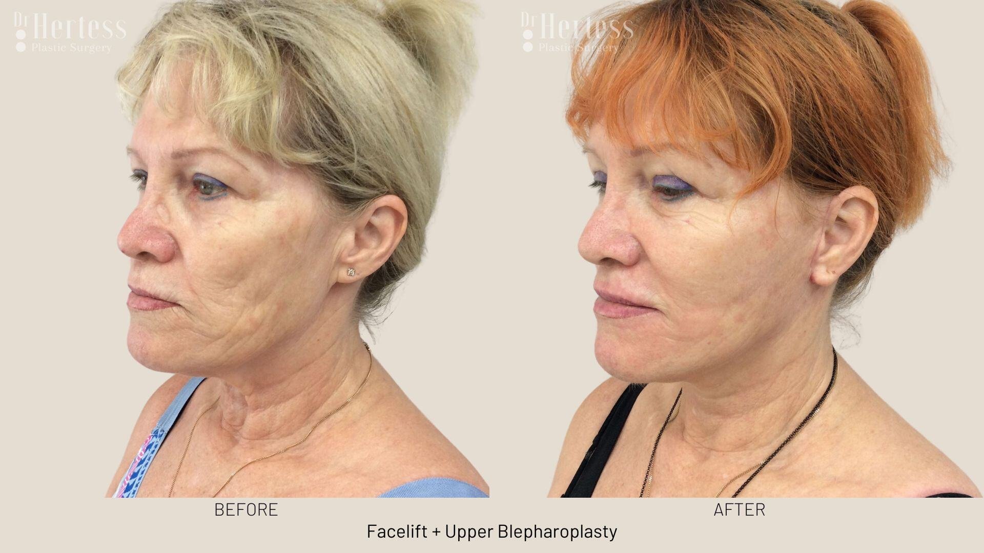 facelift before and after photos