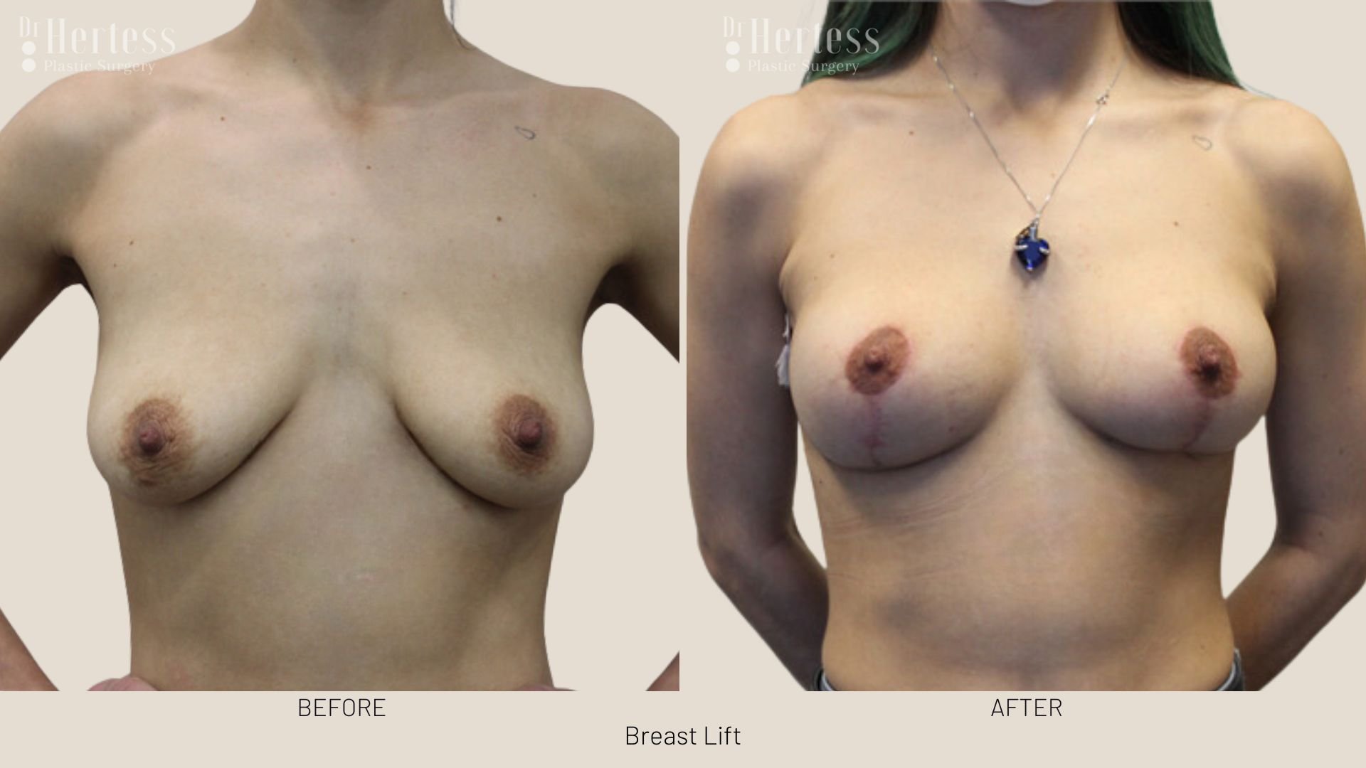 before and after breast uplift