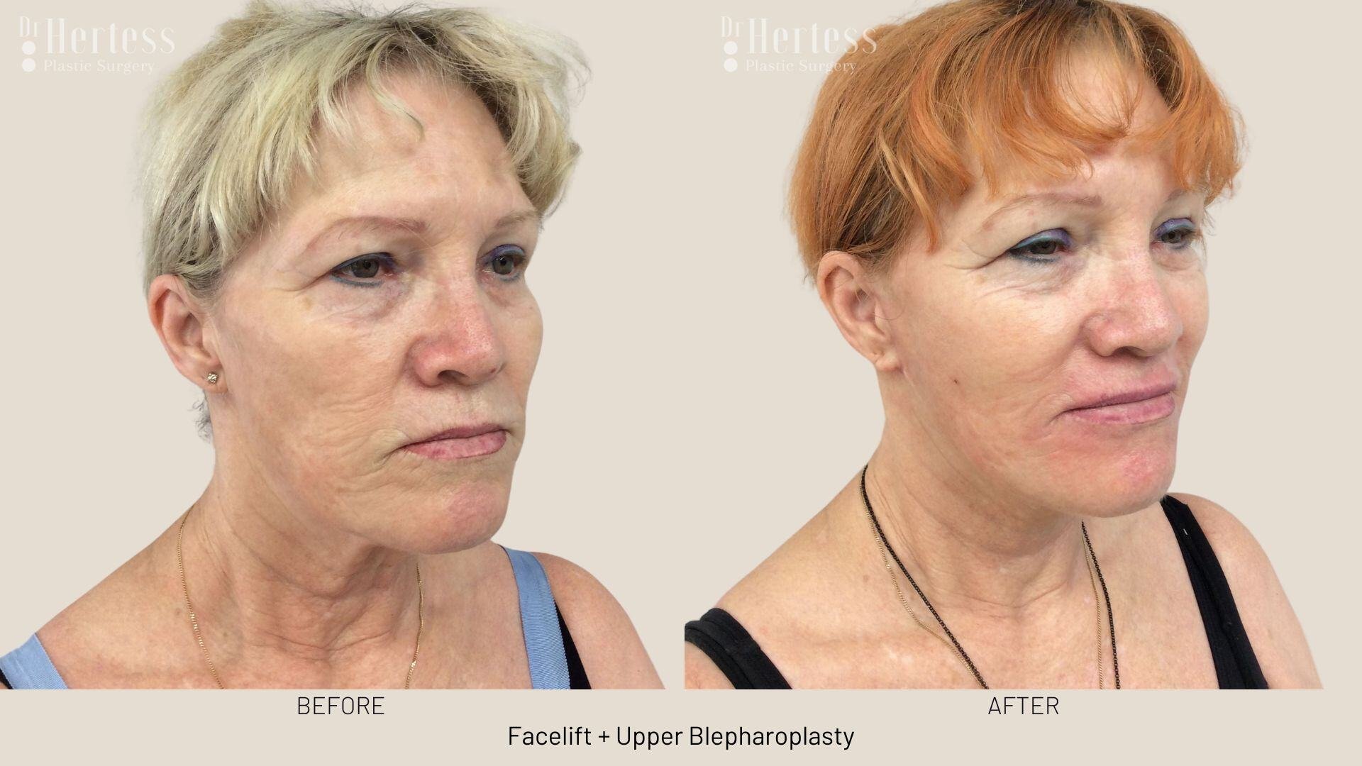 facelift before and after photos