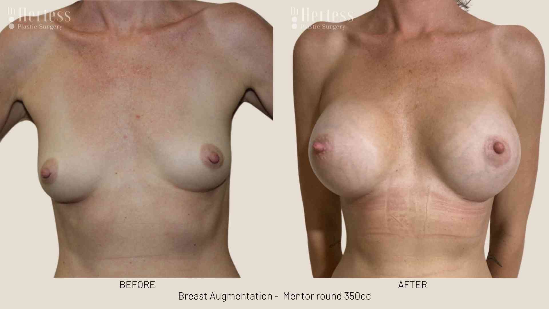 breast enlargement before and after