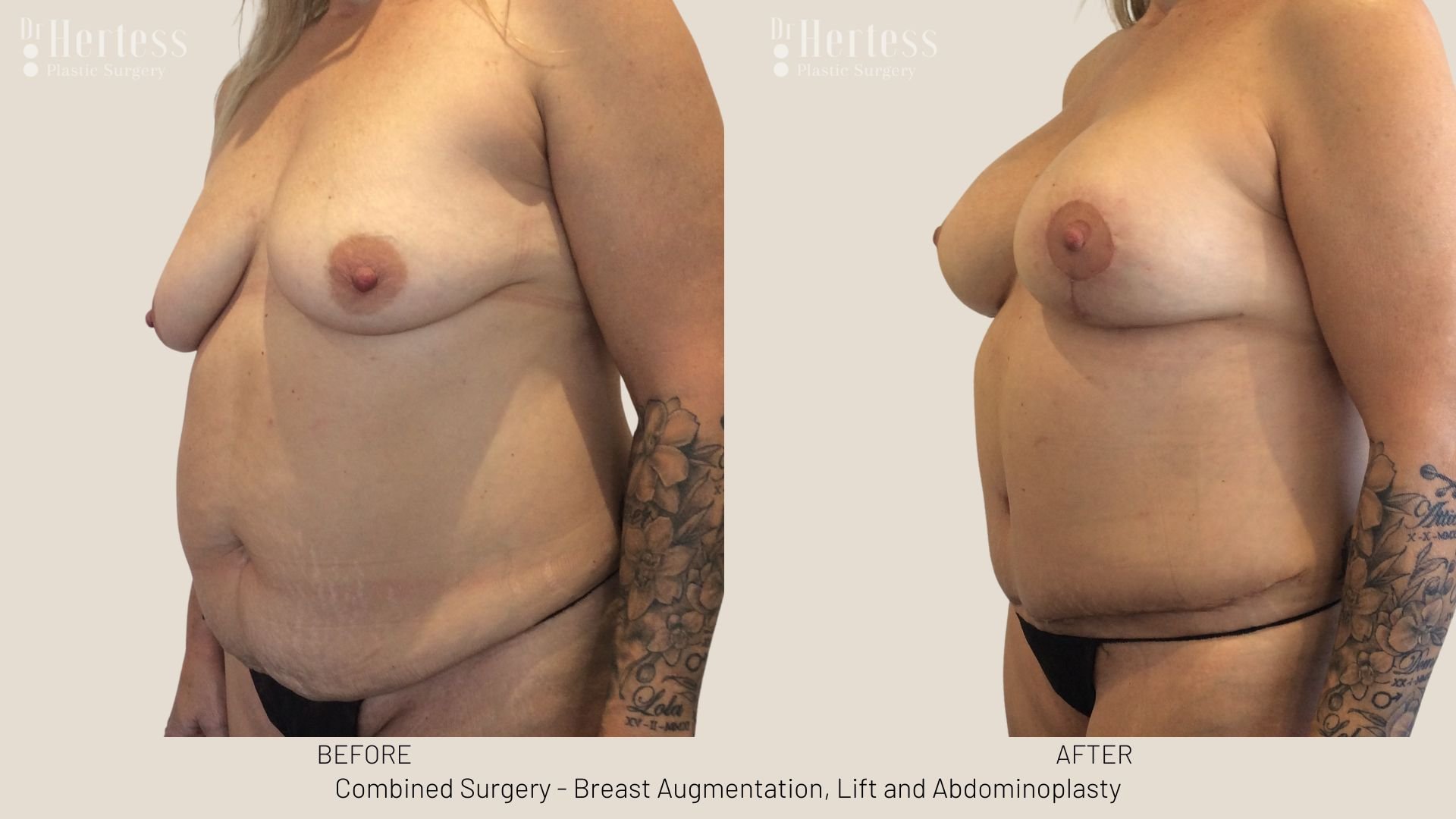 tummy tuck after pregnancy