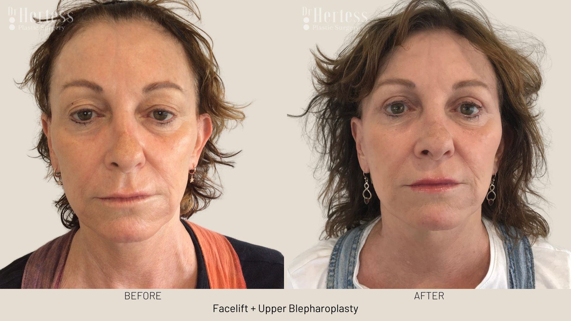 facelift before and after photos