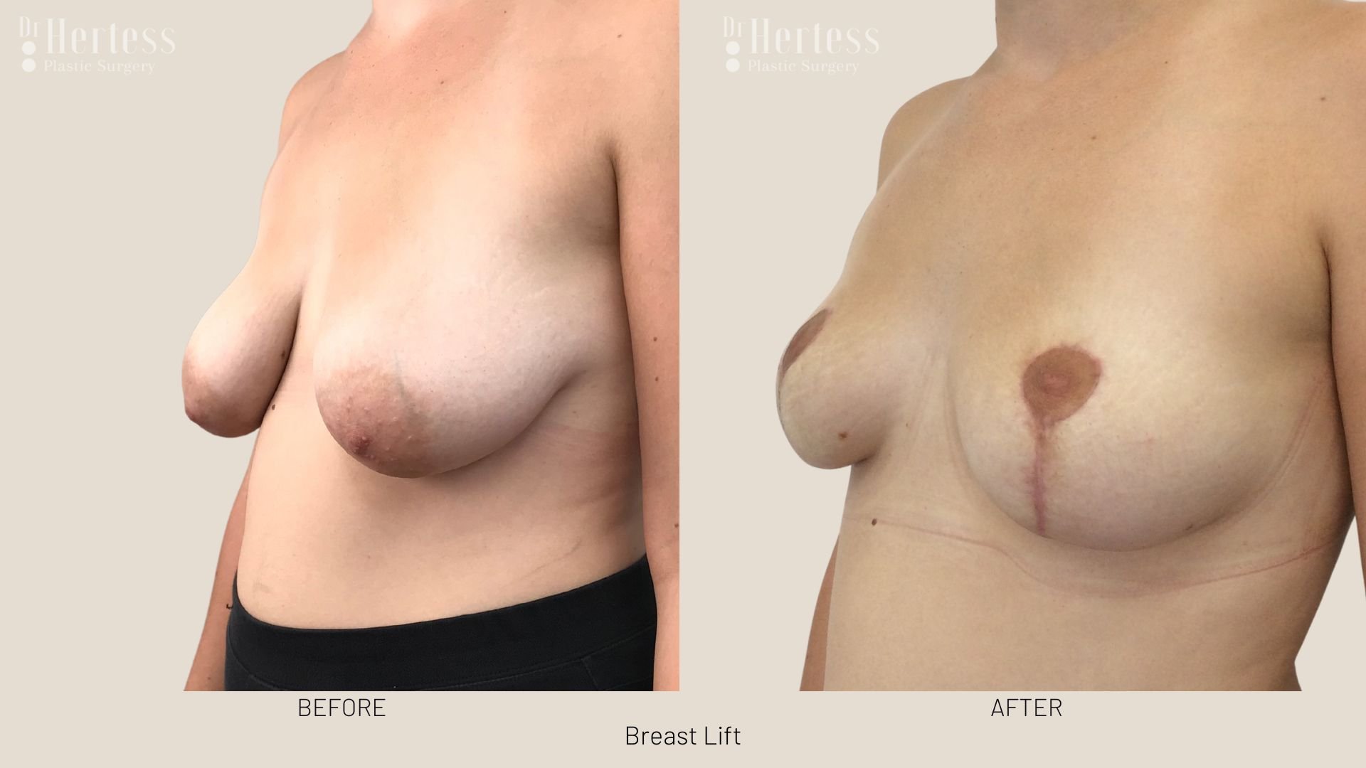 breast lift no implant