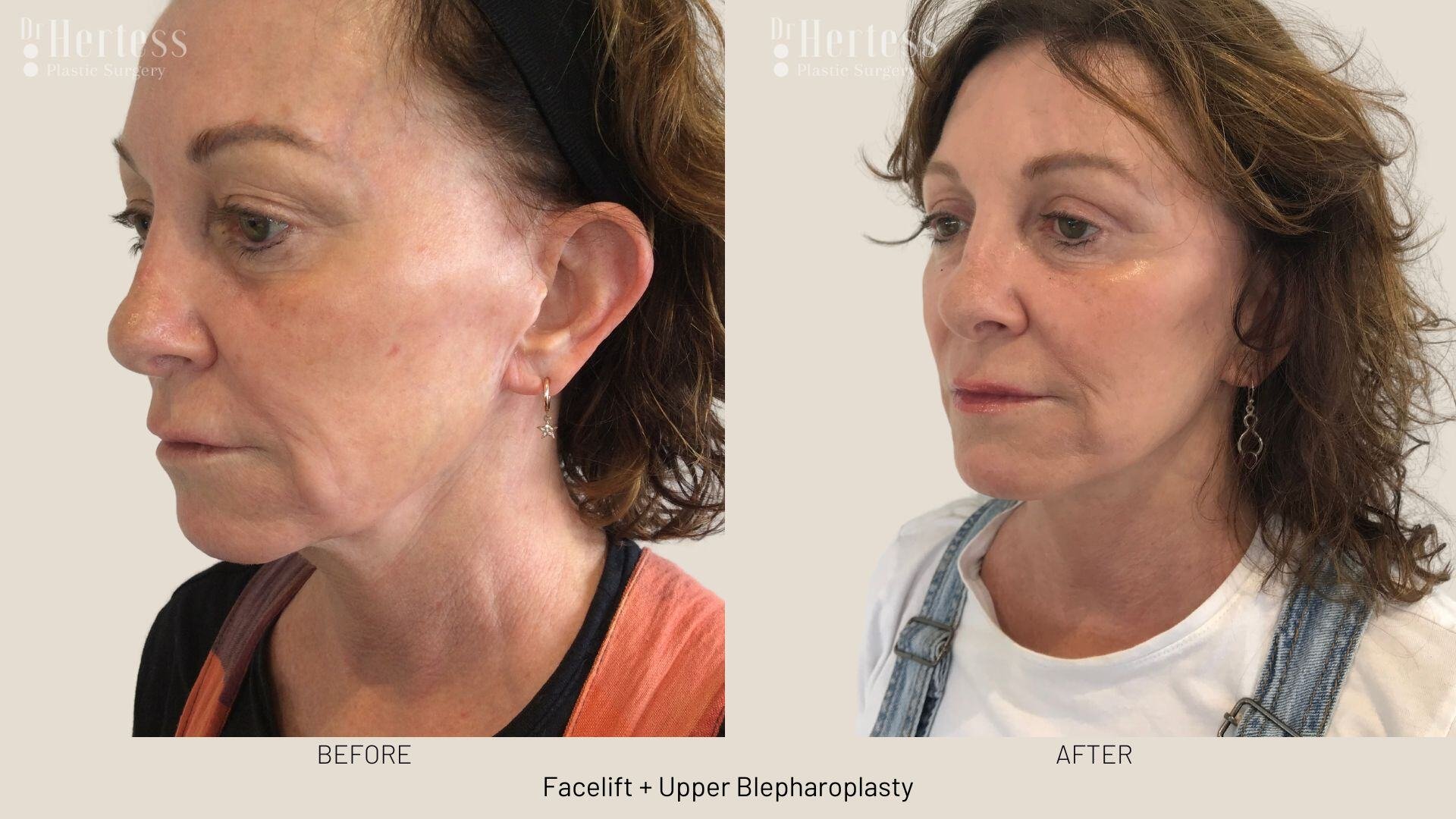 facelift before and after photos