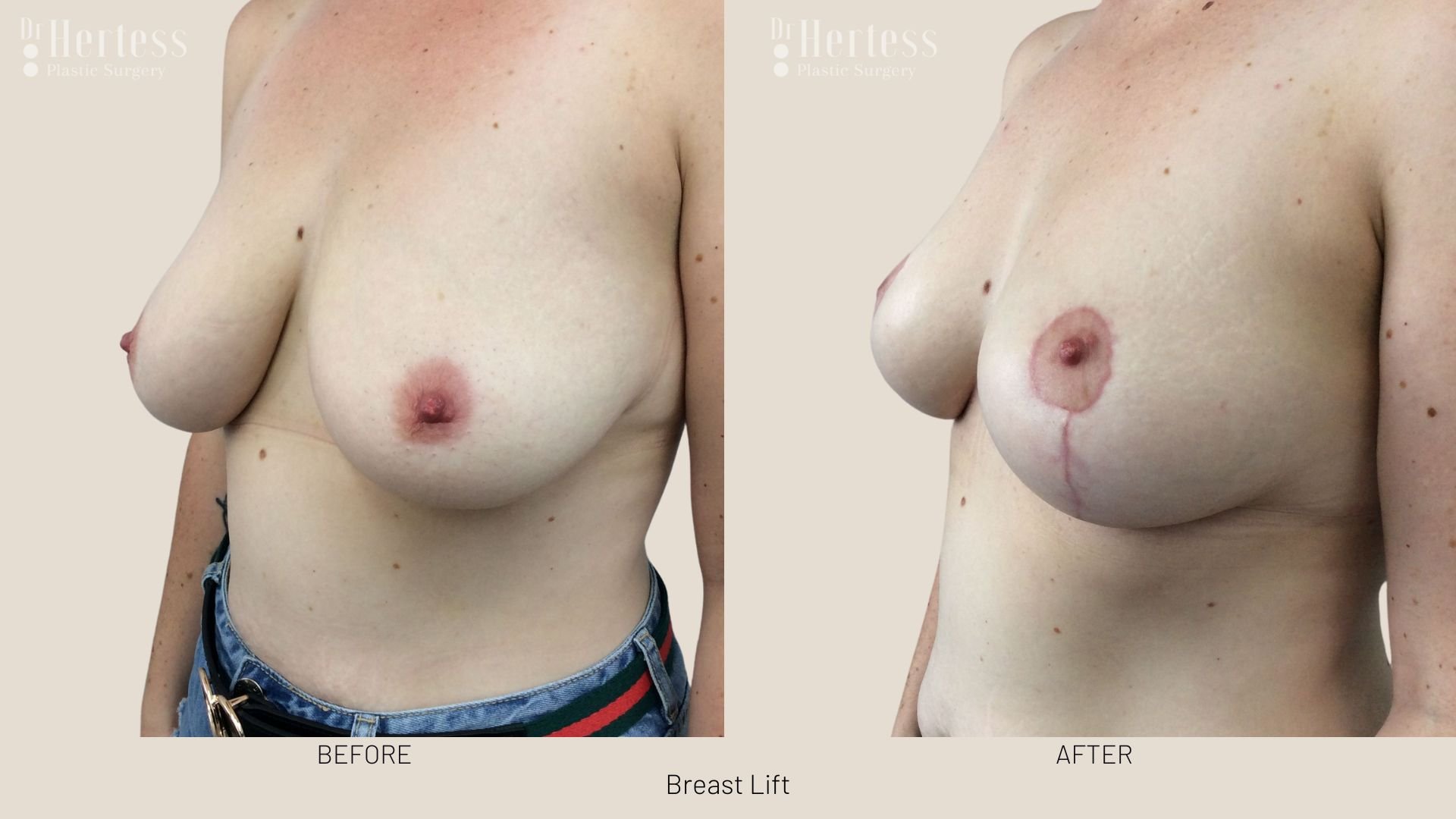 breast lift before and afters