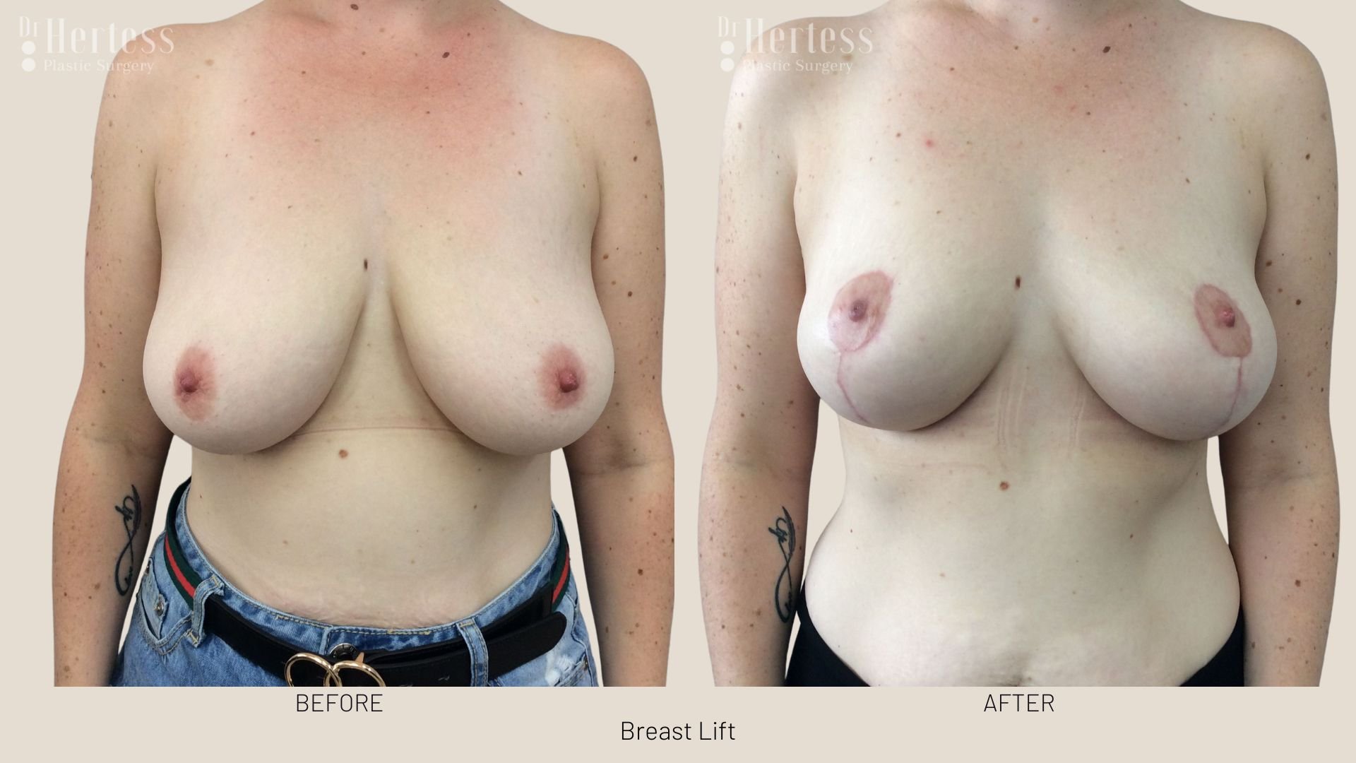 breast lift before and afters