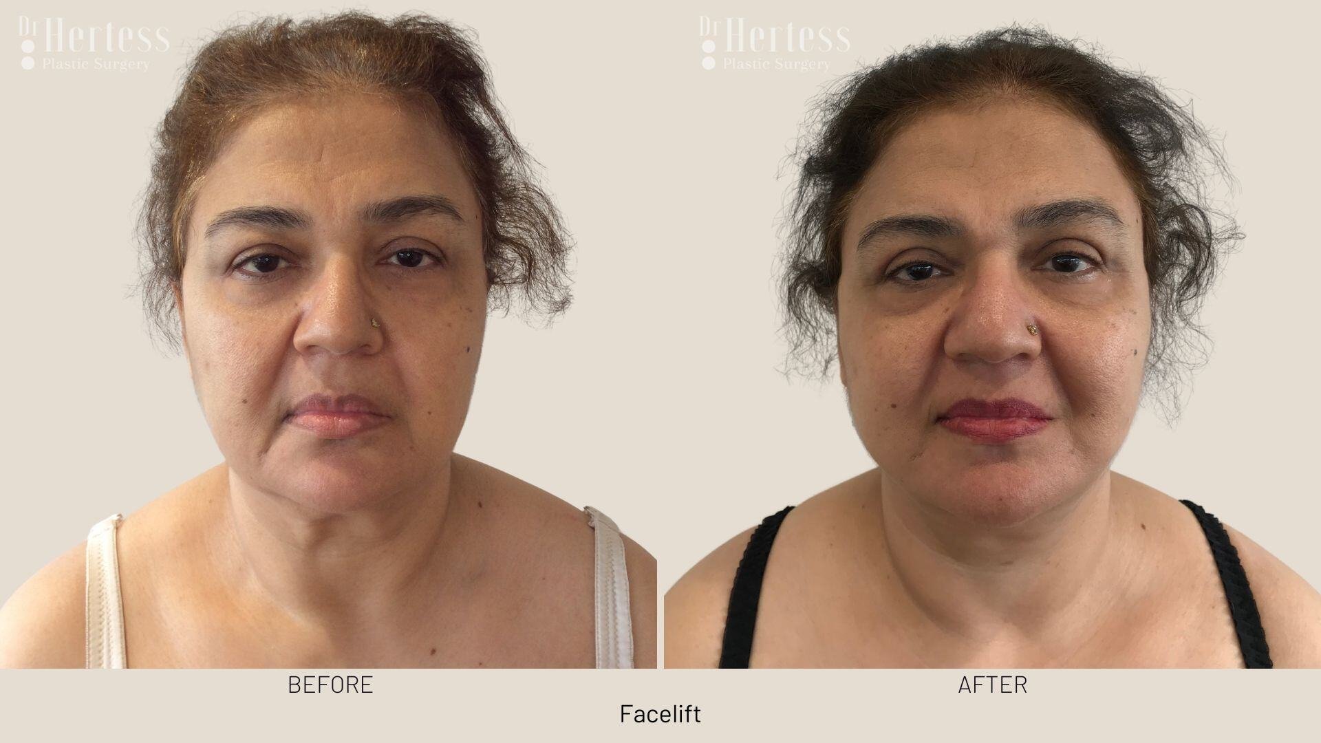 facelift before and after photos