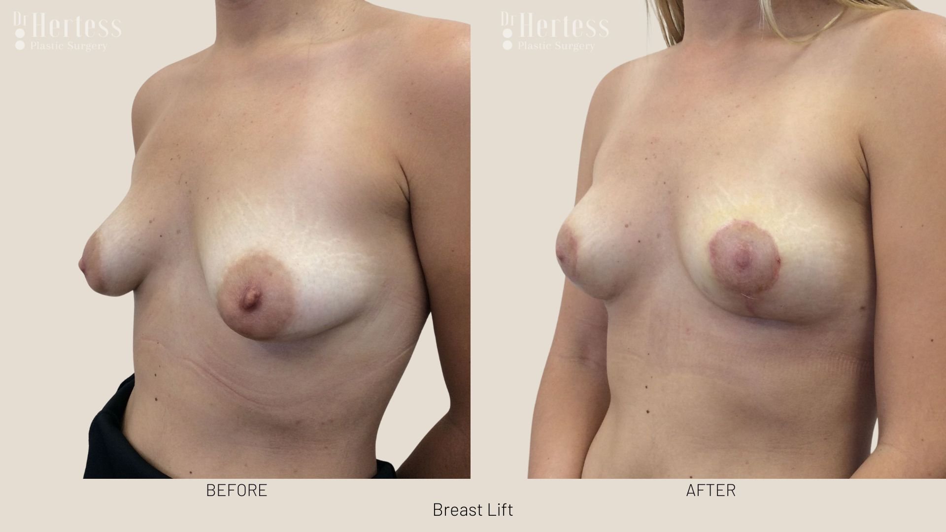 breast lift before and afters