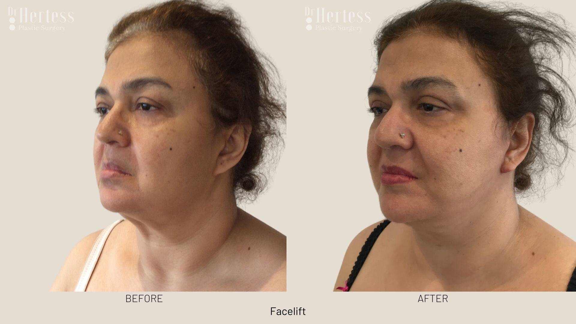 facelift before and after photos