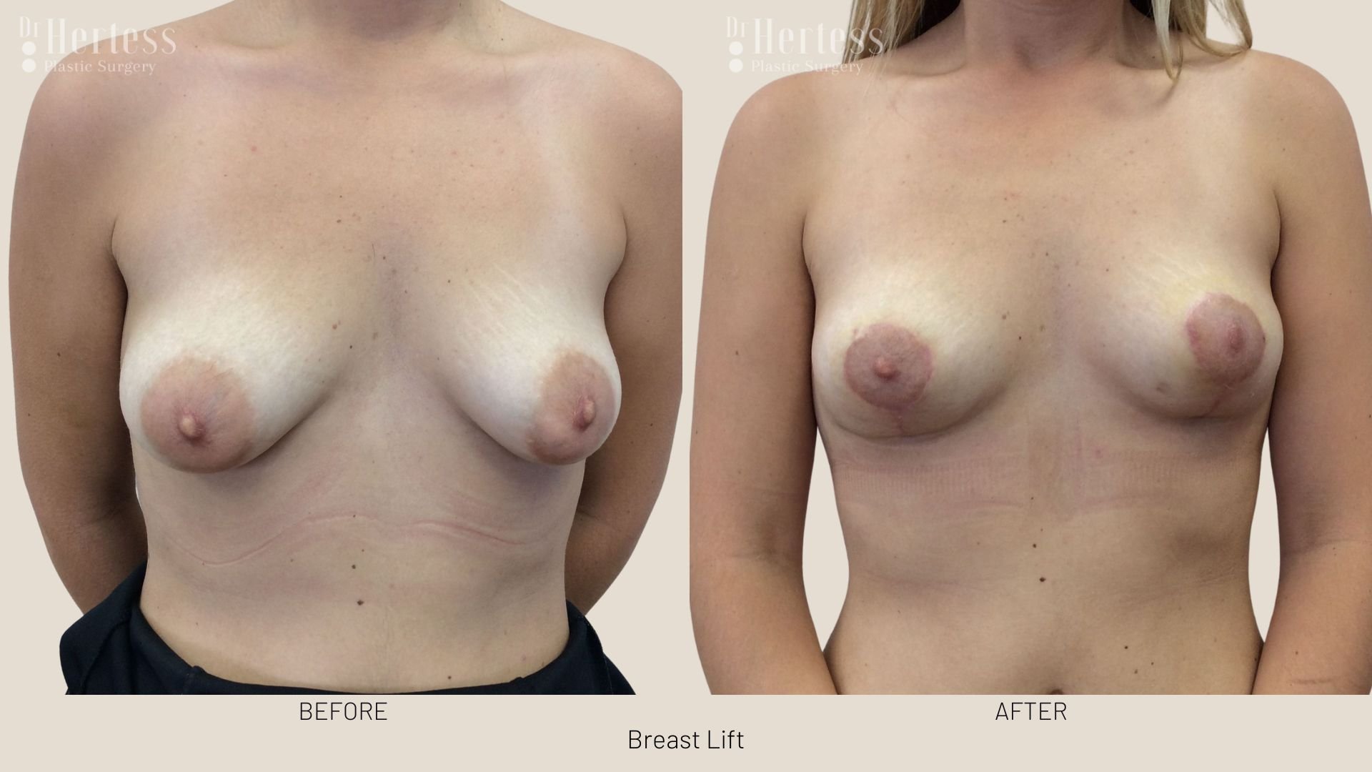 breast lift before and afters