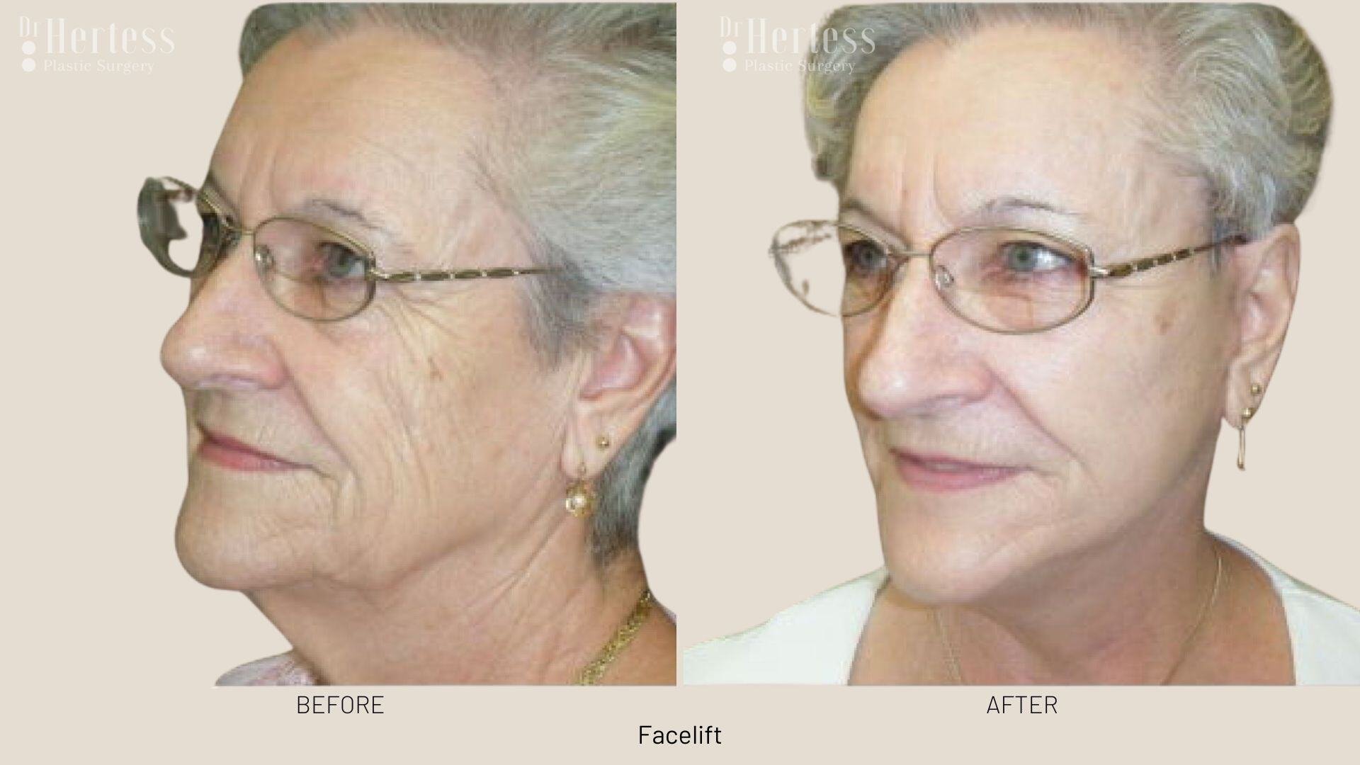 facelift before and after photos