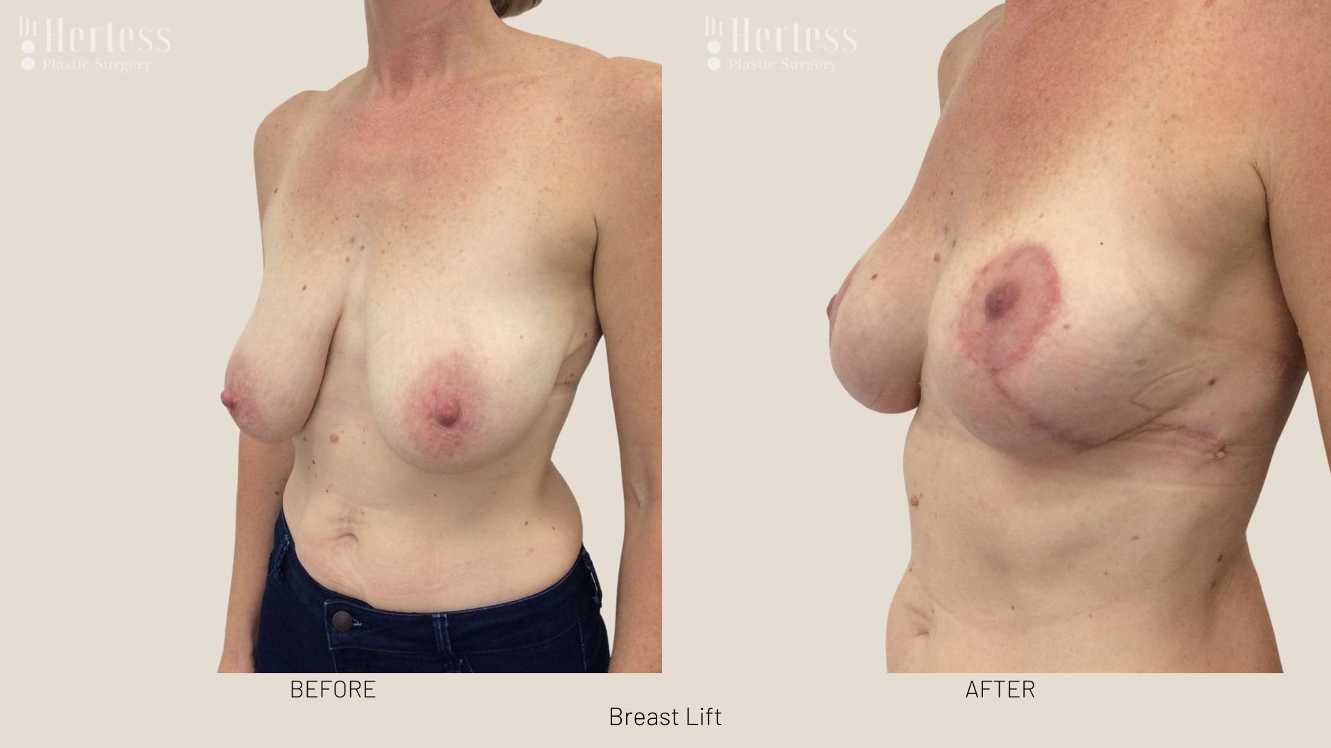 breast lift before and afters