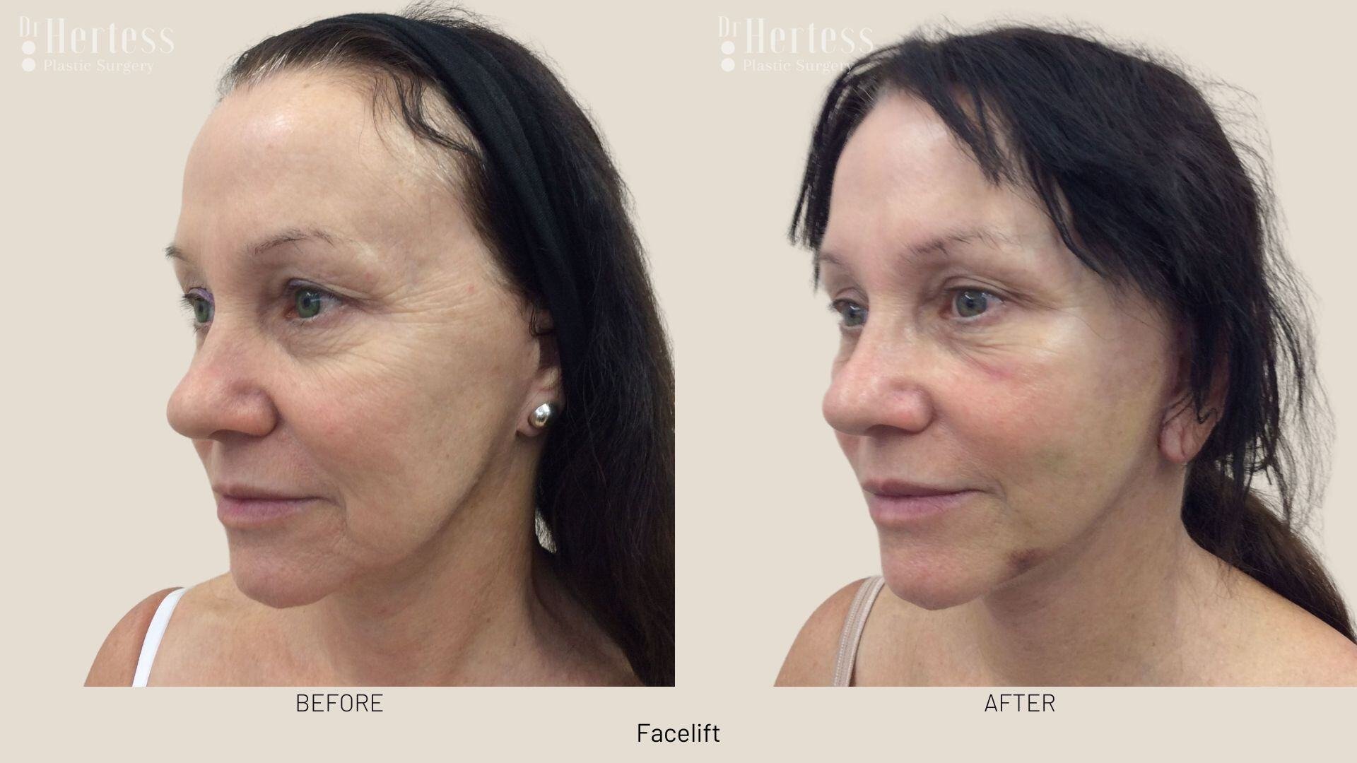 facelift before and after photos