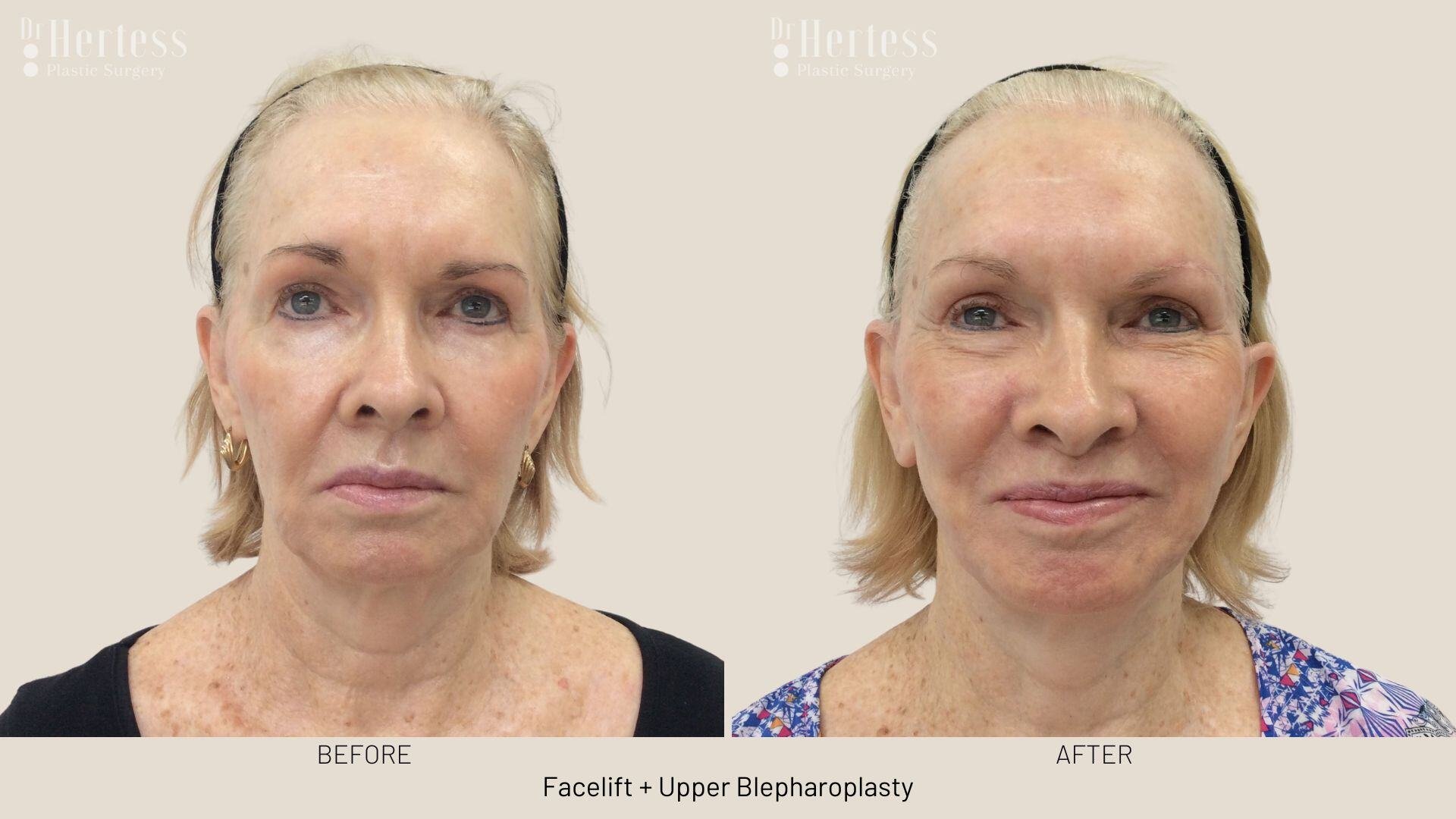 facelift before and after photos